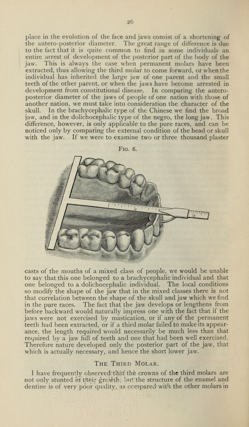place in the evolution of the face and jaws consist of a shortening of the antero-posterior diameter. The great range of difference is due to the fact that it is quite common to find in some individuals an entire arrest of development of the posterior part of the body of the jaw. This is always the case when permanent molars have been extracted, thus allowing the third molar to come forward, or when the individual has inherited the large jaw of one parent and the small teeth of the other parent, or when the jaws have become arrested in development from constitutional disease. In comparing the antero- posterior diameter of the jaws of people of one nation with those of another nation, we must take into consideration the character of the skull. In the brachycephalic type of the Chinese we find the broad jaw, and in the dolichocephalic type of the negro, the long jaw. This difference, however, is only applicable to the pure races, and can be noticed only by comparing the external condition of the head or skull with the jaw. If we were to examine two or three thousand plaster Fig. 6. casts of the mouths of a mixed class of people, we would be unable to say that this one belonged to a brachycephalic individual and that one belonged to a dolichocephalic individual. The local conditions so modify the shape of the jaw that in the mixed classes there is not that correlation between the shape of the skull and jaw which we find in the pure races. The fact that the jaw develops or lengthens from before backward would naturally impress one with the fact that if the jaws were not exercised by mastication, or if any of the permanent teeth had been extracted, or if a third molar failed to make its appear- ance, the length required would necessarily be much less than that required by a jaw full of teeth and one that had been well exercised. Therefore nature developed only the posterior part of the jaw, that which is actually necessary, and hence the short lower jaw. The Third Molar. I have frequently observed'tllat-the crowns of the third molars are not only stunted itttlKeir growth, but'the structure of the enamel and dentine is of very poor quality, as ccn>paredwith the other molars in