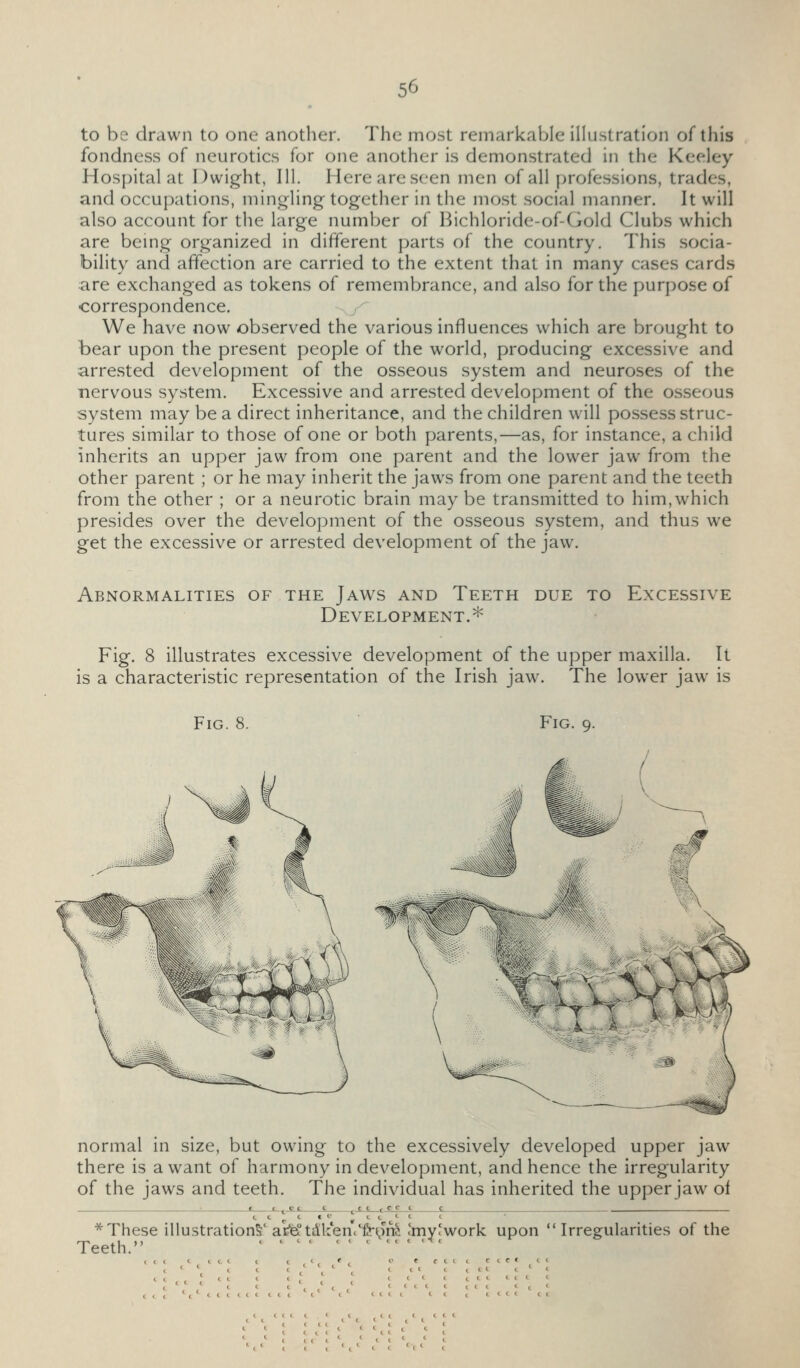 to be drawn to one another. The most remarkable iUustration of this fondness of neurotics for one another is demonstrated in the Keeley Hos[)ital at Dwight, 111. Here are seen men of all professions, trades, and occupations, mingling together in the mo.st social manner. It will also account for the large number of Bichloride-of-Gold Clubs which are bemg organized in different parts of the country. This socia- bility and affection are carried to the extent that in many cases cards are exchanged as tokens of remembrance, and also for the purpose of •correspondence. We have now observed the various influences which are brought to bear upon the present people of the world, producing excessive and arrested development of the osseous system and neuroses of the nervous system. Excessive and arrested development of the osseous system may be a direct inheritance, and the children will possess struc- tures similar to those of one or both parents,—as, for instance, a child inherits an upper jaw from one parent and the lower jaw from the other parent ; or he may inherit the jaws from one parent and the teeth from the other ; or a neurotic brain may be transmitted to him, which presides over the development of the osseous system, and thus we get the excessive or arrested development of the jaw. Abnormalities of the Jaws and Teeth due to Excessive Development.* Fig. 8 illustrates excessive development of the upper maxilla. It is a characteristic representation of the Irish jaw. The lower jaw is Fig. 8. Fig. 9. normal in size, but owing to the excessively developed upper jaw there is a want of harmony in development, and hence the irregularity of the jaws and teeth. The individual has inherited the upper jaw of * These illustration^'aiE^tdken.'frt^ni 'my'work upon Irregularities of the Teeth. < < - . . . c . .k.
