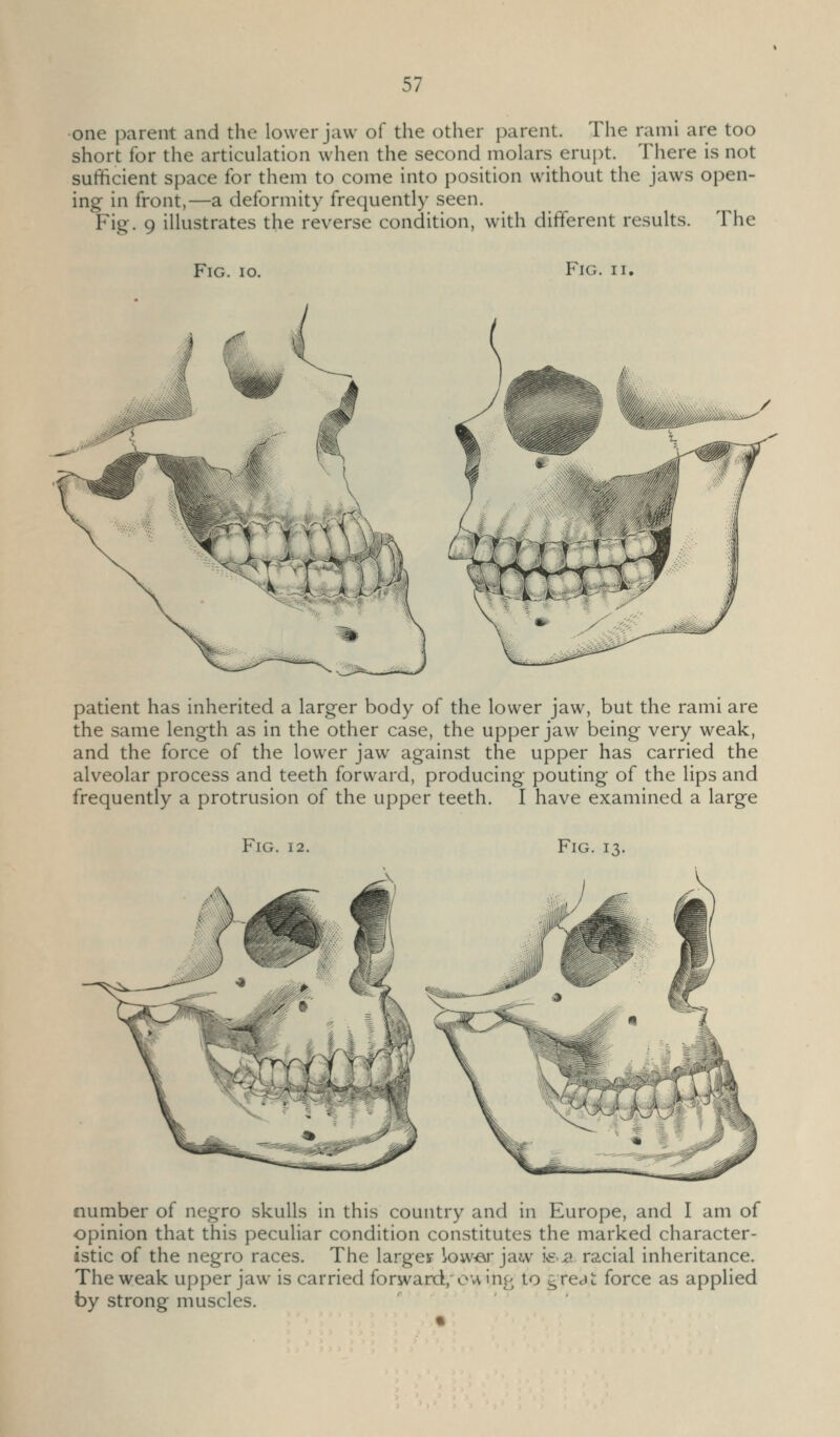 one parent and the lower jaw of the other parent. The rami are too short for the articulation when the second molars erupt. There is not sufficient space for them to come into position without the jaws open- ing in front,—a deformity frequently seen. Fig. 9 illustrates the reverse condition, with different results. The Fig. 10. Fig. II. patient has inherited a larger body of the lower jaw, but the rami are the same length as in the other case, the upper jaw being very weak, and the force of the lower jaw against the upper has carried the alveolar process and teeth forward, producing pouting of the lips and frequently a protrusion of the upper teeth. I have examined a large Fig. 12. Fig. 13. number of negro skulls in this country and in Europe, and I am of opinion that this peculiar condition constitutes the marked character- istic of the negro races. The larger low^r jaw i^-a racial inheritance. The weak upper jaw is carried forward.o'vvin^ to grejc force as applied by strong muscles.