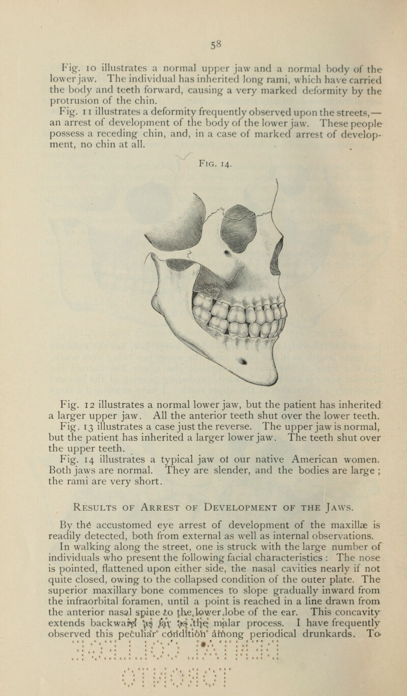 5« Fig-. lo illustrates a normal upper jaw and a normal body of the lower jaw. The individual has inherited long rami, whieh have carried the body and teeth forward, causing a very marked deformity by the protrusion of the chin. Fig. 11 illustrates a deformity frequently observed upon the streets,— an arrest of development of the body of the lower jaw. These people possess a receding chin, and, in a case of marked arrest of develop- ment, no chin at all. Fig. 14. Fig. 12 illustrates a normal lower jaw, but the patient has inherited a larger upper jaw. All the anterior teeth shut over the lower teeth. Fig. 13 illustrates a case just the reverse. The upper jaw is normal, but the patient has inherited a larger lower jaw. The teeth shut over the upper teeth. Fig. 14 illustrates a typical jaw ot our native American women. Both jaws are normal. They are slender, and the bodies are large ; the rami are very short. Results of Arrest of Development of the Jaws. By th^ accustomed eye arrest of development of the maxillae is readily detected, both from external as well as internal observations. In walking along the street, one is struck with the large number of individuals who present the following facial characteristics : The nose is pointed, flattened upon either side, the nasal cavities nearly if not quite closed, owing to the collapsed condition of the outer plate. The superior maxillary bone commences to slope gradually inward from the infraorbital foramen, until a point is reached in a line drawn from the anterior nasal spine io |:he. lower Jobe of the ear. This concavity extends backwa^ ^^ /g,\' \}d .'ti^ej malar process. I have frequently observed this peculiar' c6riditl6h' ^ifiong periodical drunkards. To> c ( 1 t t