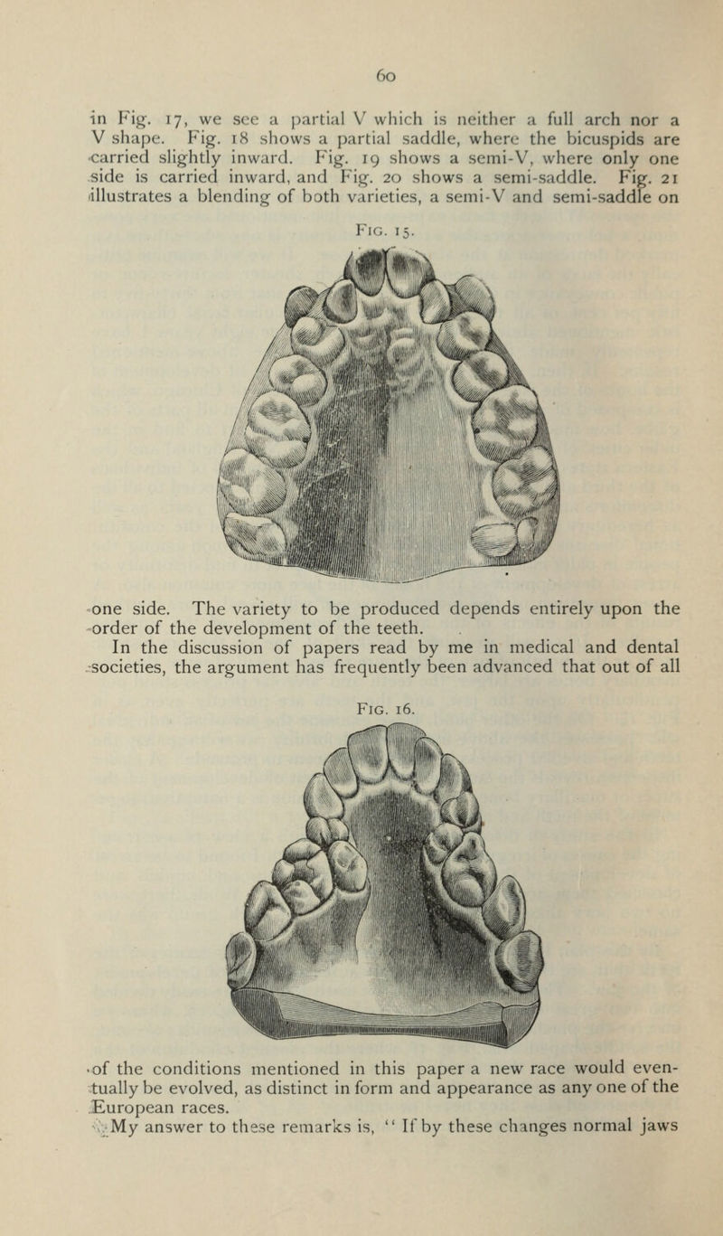 in Fig. 17, we see a partial V which is neither a full arch nor a V shape. Fig. 18 shows a partial saddle, where the bicu.spids are •carried slightly inward. Fig. 19 shows a semi-V, where only one side is carried inward, and Fig. 20 shows a semi-saddle. Fig. 21 •illustrates a blending of both varieties, a semi-V and semi-saddle on Fig. 15. <one side. The variety to be produced depends entirely upon the order of the development of the teeth. In the discussion of papers read by me in medical and dental rsocieties, the argument has frequently been advanced that out of all Fig. 16. «of the conditions mentioned in this paper a new race would even- tually be evolved, as distinct in form and appearance as any one of the .European races. •x^My answer to these remarks is,  If by these changes normal jaws