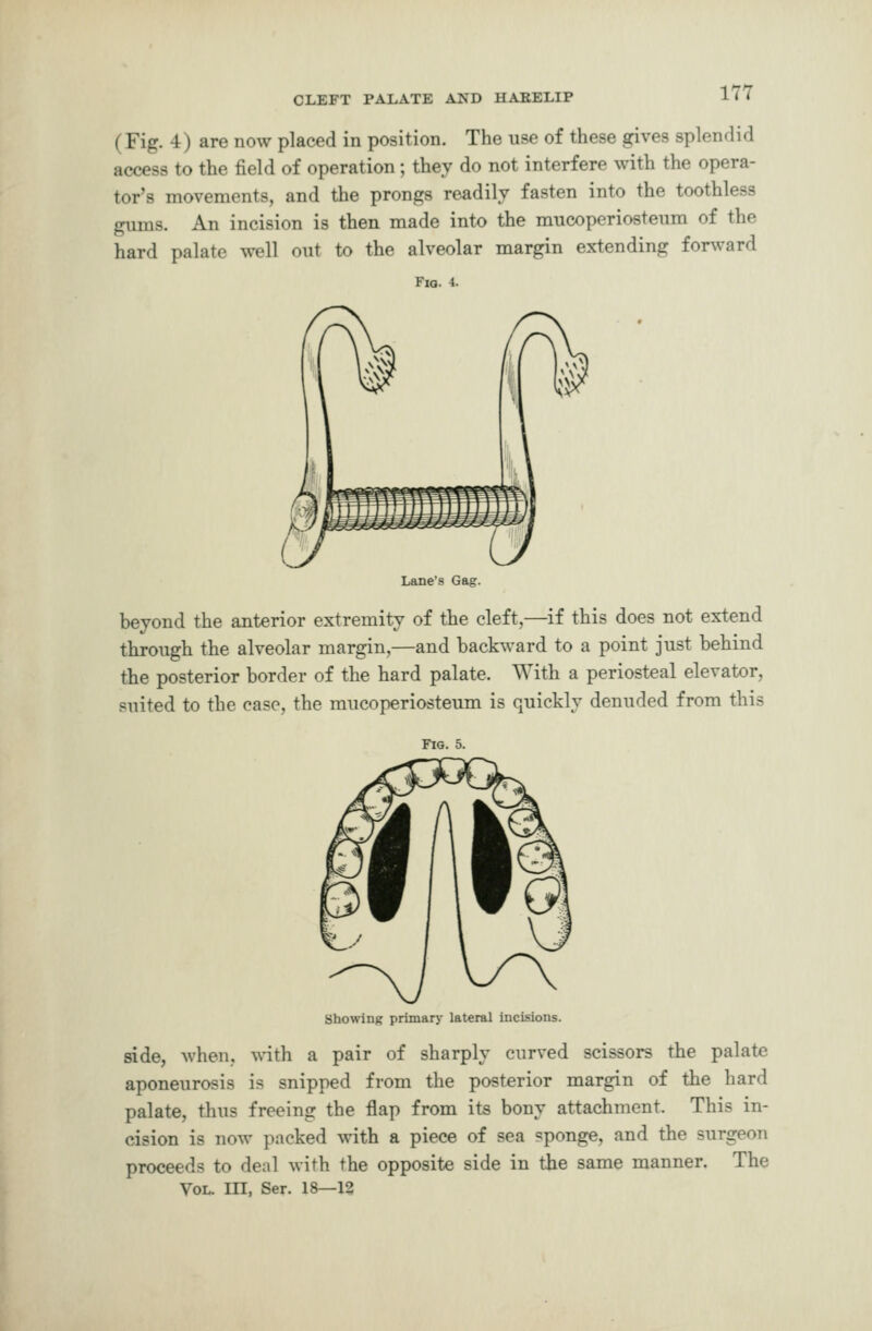 (Fig. 4) are now placed in position. The use of these gives splendid access to the field of operation; they do not interfere with the opera- tor's movements, and the prongs readily fasten into the toothless glims. An incision is then made into the mucoperiosteum of the hard palate well out to the alveolar margin extending forward Fig. 4. Lane's Gag. beyond the anterior extremity of the cleft,—if this does not extend through the alveolar margin,—and backward to a point just behind the posterior border of the hard palate. With a periosteal elevator, suited to the case, the mucoperiosteum is quickly denuded from this Fig. 5. Showing primary lateral incisions. side, when, with a pair of sharply curved scissors the palate aponeurosis is snipped from the posterior margin of the hard palate, thus freeing the flap from its bony attachment. This in- cision is now packed with a piece of sea ?ponge, and the surgeon proceeds to deal with the opposite side in the same manner. The Vol. Ill, Ser. 18—13