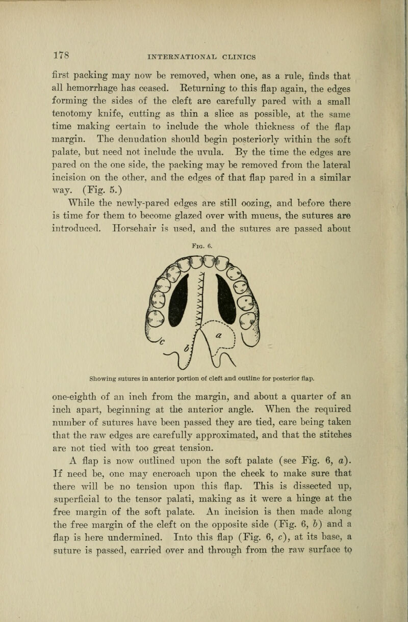 1Y8 first packing may now be removed, when one, as a rule, finds that all hemorrhage has ceased. Returning to this flap again, the edges forming the sides of the cleft are carefully pared A\ath a small tenotomy knife, cutting as thin a slice as possible, at the same time making certain to include the whole thickness of the flap margin. The denudation should begin posteriorly within the soft palate, but need not include the uvula. By the time the edges are pared on the one side, the packing may be removed from the lateral incision on the other, and the edges of that flap pared in a similar way. (Fig. 5.) While the newly-pared edges are still oozing, and before there is time for them to become glazed over with mucus, the sutures are introduced. Horsehair is used, and the sutures are passed about Fig. 6. Showing sutures in anterior portion of cleft and outline for posterior flap. one-eighth of an inch from the margin, and about a quarter of an inch apart, beginning at the anterior angle. When the required number of sutures have been passed they are tied, care being taken that the raw edges are carefully approximated, and that the stitches are not tied with too great tension. A flap is now outlined upon the soft palate (see Fig. 6, a). If need be, one may encroach upon the cheek to make sure that there will be no tension upon this flap. This is dissected up, superficial to the tensor palati, making as it were a hinge at the free margin of the soft palate. An incision is then made along the free margin of the cleft on the opposite side (Fig. 6, 6) and a flap is here undermined. Into this flap (Fig. 6, c), at its base, a suture is passed, carried over and through from the raw surface to