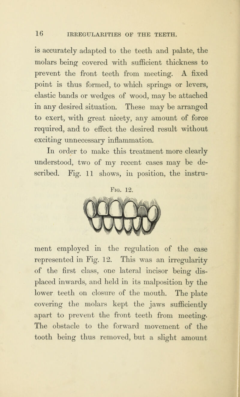 is accurately adapted to the teeth and palate, the molars being covered with sufficient thickness to prevent the front teeth from meeting. A fixed point is thus formed, to which springs or levers, elastic bands or wedges of wood, may be attached in any desired situation. These may be arranged to exert, with great nicety, any amount of force required, and to effect the desired result without exciting unnecessary inflammation. In order to make this treatment more clearly understood, two of my recent cases may be de- scribed. Fig. 11 shows, in position, the instru- Fig. 12. ment employed in the regulation of the case represented in Fig. 12. This was an irregularity of the first class, one lateral incisor being dis- placed inwards, and held in its malposition by the lower teeth on closure of the mouth. The plate covering the molars kept the jaws sufficiently apart to prevent the front teeth from meeting. The obstacle to the forward movement of the tooth being thus removed, but a slight amount