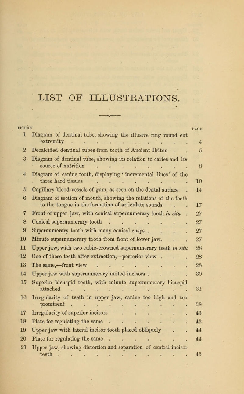 LIST OF ILLUSTRATIONS. FIGURE PAGE 1 Diagram of dentinal tube, showing the illusive ring round cut extremity . . . . . .... . . 4 2 Decalcified dentinal tubes from tooth of Ancient Briton . . 5 3 Diagram of dentinal tube, showing its relation to caries and its source of nutrition 4 Diagram of canine tooth, displaying ' incremental lines' of the three hard tissues . 5 Capillary blood-vessels of gum, as seen on the dental surface 6 Diagram of section of mouth, showing the relations of the teeth to the tongue in the formation of articulate sounds 7 Front of upper jaw, with conical supernumerary tooth in situ 8 Conical supernumerary tooth 9 Supernumerary tooth with many conical cusps . 10 Minute supernumerary tooth from front of lower jaw. 11 Upper jaw, with two cubic-crowned supernumerary teeth in situ 28 12 One of these teeth after extraction,—posterior view ... 28 13 The same,—front view 28 14 Upper jaw with supernumerary united incisors .... 30 15 Superior bicuspid tooth, with minute supernumerary bicuspid attached <. . . . 31 16 Irregularity of teeth in upper jaw, canine too high and too prominent 38 17 Irregularity of superior incisors 43 18 Plate for regulating the same 43 19 Upper jaw with lateral incisor tooth placed obliquely . . 44 20 Plate for regulating the same 44 21 Upper jaw, showing distortion and separation of central incisor 45 teeth 8 10 14 17 27 27 27 27