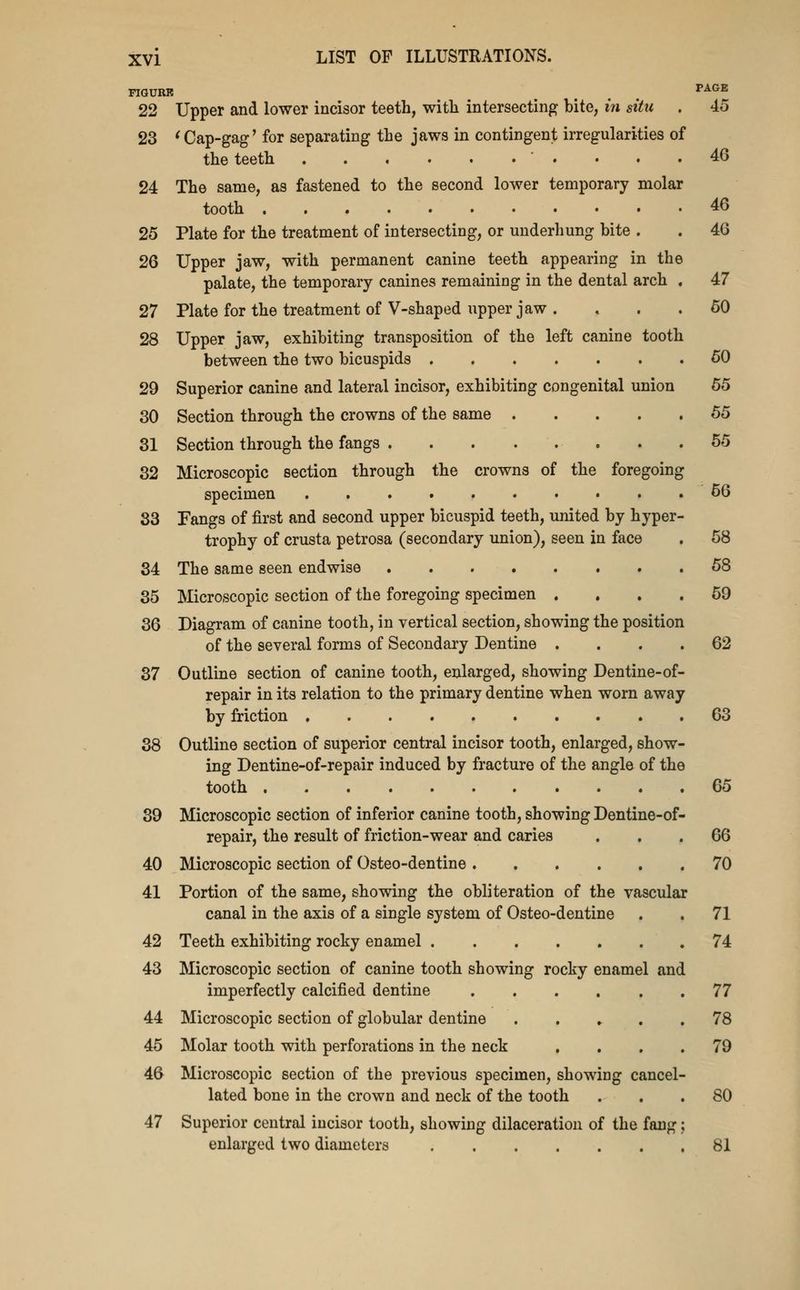 FIQURK ^ ... VA.GK 22 Upper and lower incisor teeth, with intersecting bite, in situ . 45 23 'Cap-gag' for separating the jaws in contingent irregularities of the teeth 46 24 The same, as fastened to the second lower temporary molar tooth 46 25 Plate for the treatment of intersecting, or underhung bite . . 46 26 Upper jaw, with permanent canine teeth appearing in the palate, the temporary canines remaining in the dental arch , 47 27 Plate for the treatment of V-shaped upper jaw . ... 60 28 Upper jaw, exhibiting transposition of the left canine tooth between the two bicuspids 50 29 Superior canine and lateral incisor, exhibiting congenital union 65 30 Section through the crowns of the same 55 31 Section through the fangs 55 32 Microscopic section through the crowns of the foregoing specimen 66 83 Fangs of first and second upper bicuspid teeth, united by hyper- trophy of crusta petrosa (secondary union), seen in face . 58 34 The same seen endwise 58 35 Microscopic section of the foregoing specimen .... 69 36 Diagram of canine tooth, in vertical section, showing the position of the several forms of Secondary Dentine .... 62 37 Outline section of canine tooth, enlarged, showing Dentine-of- repair in its relation to the primary dentine when worn away by friction 63 38 Outline section of superior central incisor tooth, enlarged, show- ing Dentine-of-repair induced by fracture of the angle of the tooth 65 39 Microscopic section of inferior canine tooth, showing Dentine-of- repair, the result of friction-wear and caries ... 66 40 Microscopic section of Osteo-dentine 70 41 Portion of the same, showing the obliteration of the vascular canal in the axis of a single system of Osteo-dentine . . 71 42 Teeth exhibiting rocky enamel 74 43 Microscopic section of canine tooth showing rocky enamel and imperfectly calcified dentine 77 44 Microscopic section of globular dentine . . »- . .78 45 Molar tooth with perforations in the neck .... 79 46 Microscopic section of the previous specimen, showing cancel- lated bone in the crown and neck of the tooth ... 80 47 Superior central incisor tooth, showing dilaceration of the fang; enlarged two diameters 81