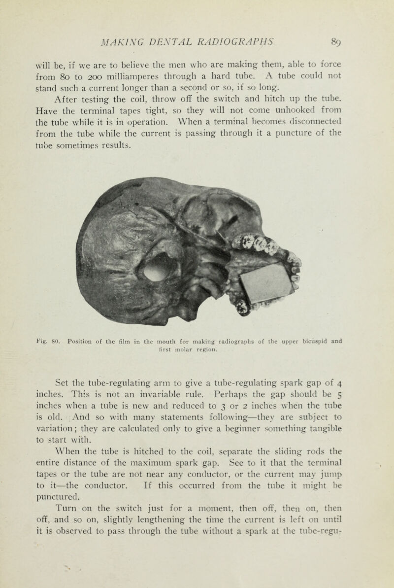 will be, if we are to believe the men who are making them, able to force from 80 to 200 milliamperes through a hard tube. A tube could not stand such a current longer than a secopd or so, if so long. After testing the coil, throw off the switch and hitch up the tube. Have the terminal tapes tight, so they will not come unhooked from the tube while it is in operation. When a terminal becomes disconnected from the tube while the current is passing through it a puncture of the tube sometimes results. Fig. 80. Position of the film in the mouth for making radiographs of the upper bicuspid and I'lrst molar region. Set the tube-regulating arm to give a tube-regulating spark gap of 4 inches. This is not an invariable rule. Perhaps the gap should be 5 inches when a tul)e is new and reduced to 3 or 2 inches when the tube is old. And so with many statements following—they are subject to variation; they are calculated only to give a beginner something tangible to start with. When the tube is hitched to the coil, separate the sliding rods the entire distance of the maximum spark gap. See to it that the terminal tapes or the tube are not near any conductor, or the current may jump to it—the conductor. If this occurred from the tube it might be punctured. Turn on the switch just for a moment, then off. then on, then off, and so on, slightly lengthening the time the current is left on until it is observed to pass through the tube without a spark at the tube-regu-