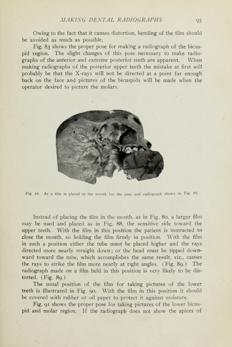 Owing to the fact that it causes distortion, bending of the film should be avoided as much as possible. Fig. 83 shows the proper pose for making a radiograph of the bicus- pid region. The slight changes of this pose necessary to make radio- graphs of the anterior and extreme posterior teeth are apparent. When making radiographs of the posterior upper teeth the mistake at first will probably be that the X-rays will not be directed at a point far enough back on the face and pictures of the bicuspids will be made when the operator desired to picture the molars. Fig. 88. As a film is placed in the mouth for the pose and radiograph shown in Fig. 89. Instead of placing the film in the mouth, as in Fig. 80, a larger film may be used and placed as in Fig. 88, the sensitive side toward the upper teeth. With the film in this position the patient is instructed to close the mouth, so holding the film firmly in position. With the film in such a position either the tube must be placed higher and the rays directed more nearly straight down; or the head must be tipped down- ward toward the tube, which accomplishes the same result, viz., causes the rays to strike the him more nearly at right angles. (Fig. 89.) The radiograph made on a film held in this position is very likely to be dis- torted. (Fig. 89.) The usual position of the film for taking pictures of the lower teeth is illustrated in Fig. 90. With the film in this position it should be covered with rubber or oil paper to protect it against moisture. Fig. 91 shows the proper pose for taking pictures of the lower bicus- pid and molar region. If the radiograph does not show the apices of