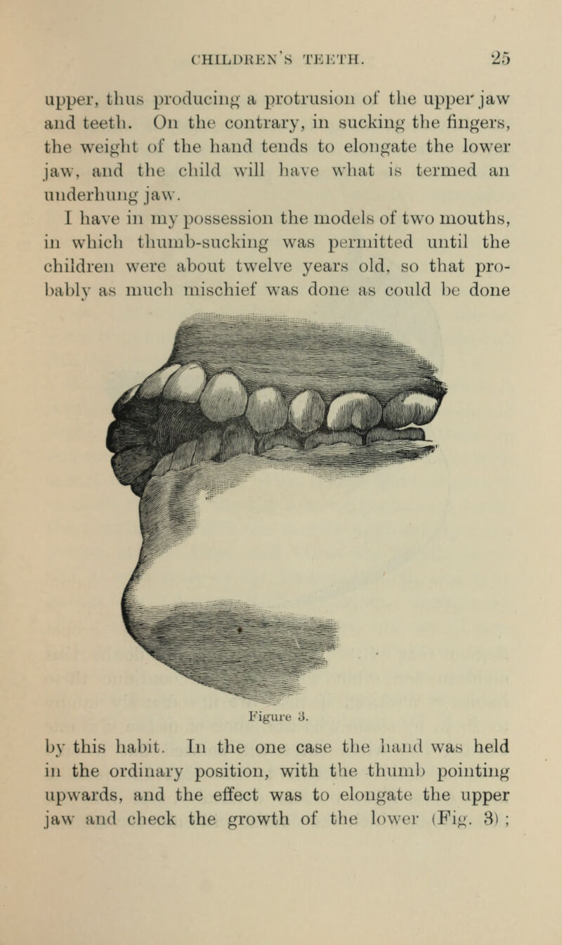 upper, thus producing a protrusion ol tlie upper jaw and teetli. On the contrary, in sucking the fingers, the weight of the hand tends to elongate the lower jaw, and the child will liave what is termed an underhung jaw. 1 have in my possession the models of two mouths, in which thumb-sucking was permitted until the children were about twelve years old, so that pro- bablv as much mischief was done as could be done Figure 3. by this habit. In the one case the hand was held in the ordinary position, with the thumb pointing upwards, and the effect was to elongate the upper jaw and check the growth of the lower (Fig. 3) ;