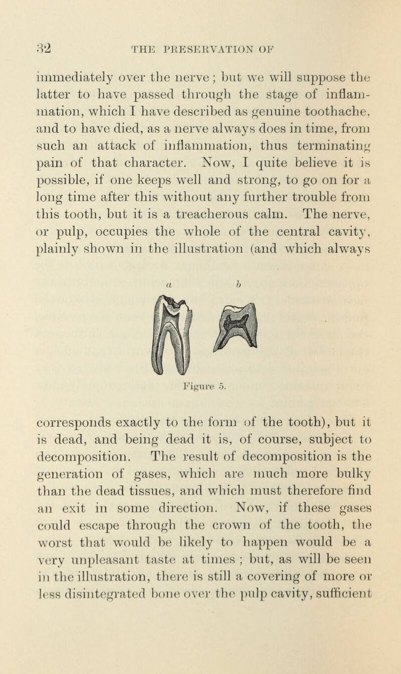82 TH]-: PllESJvRVATION OF iiiiinediately over the nerve; but we will suppose the latter to have passed through the stage of inflani- uiatioii, which I have described as genuine toothache, and to have died, as a nerve always does in time, from such an attack of inflammation, thus terminating pain of that character. Now, I quite believe it is possible, if one keeps well and strong, to go on for a long time after this without any further trouble from this tooth, but it is a treacherous calm. The nerve, or pulp, occupies the whole of the central cavity, plainly shown in the illustration (and which always Fit!f\Tve 5. corresponds exactly to the form of the tooth), but it is dead, and being dead it is, of course, subject to decomposition. The result of decomposition is the generation of gases, which are much more bulky than the dead tissues, and which must therefore find an exit in some direction. Now, if these gases could escape through the crown of the tooth, the worst that would be likely to happen would be a very unpleasant taste at times ; but, as will be seen hi the illustration, there is still a covering of more or less disintegrated bone over the pulp cavity, sufficient
