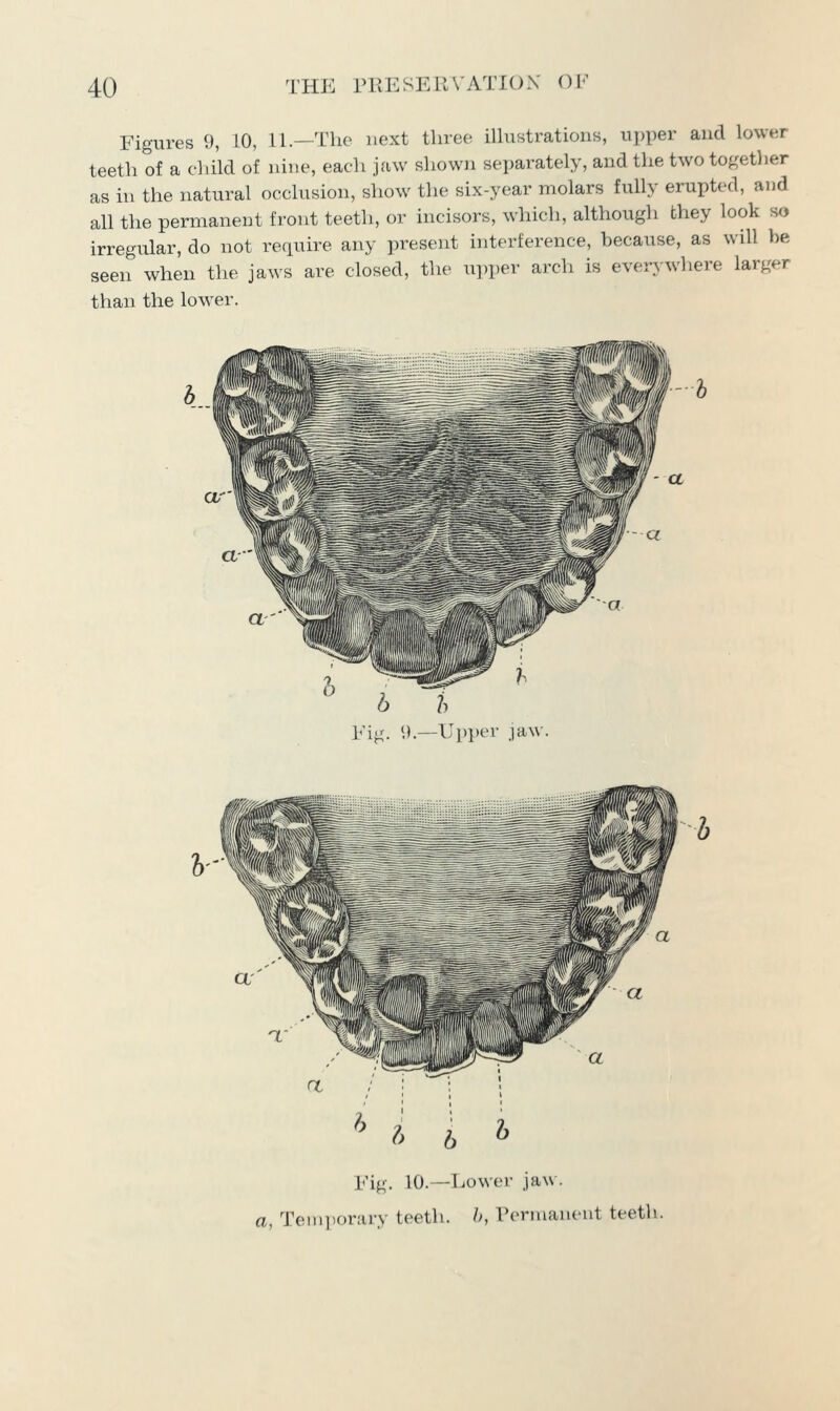 Figures 9, 10, 11.—The next three illustrations, upper and lower teeth of a child of nine, each jaw shown separately, and the two togetl)er as in the natural occlusion, show the six-year molars fuUy erupted, and all the permanent front teeth, or incisors, which, although they look so irregular, do not require any present interference, because, as will be seen when the jaws are closed, the upper arch is everj^where larger than the lower. h h Fig. '.).—Upper jaw - a Eig. 10.—Lower jaw . a, Teiiiiiorjiry teeth, h, rennanent teeth.