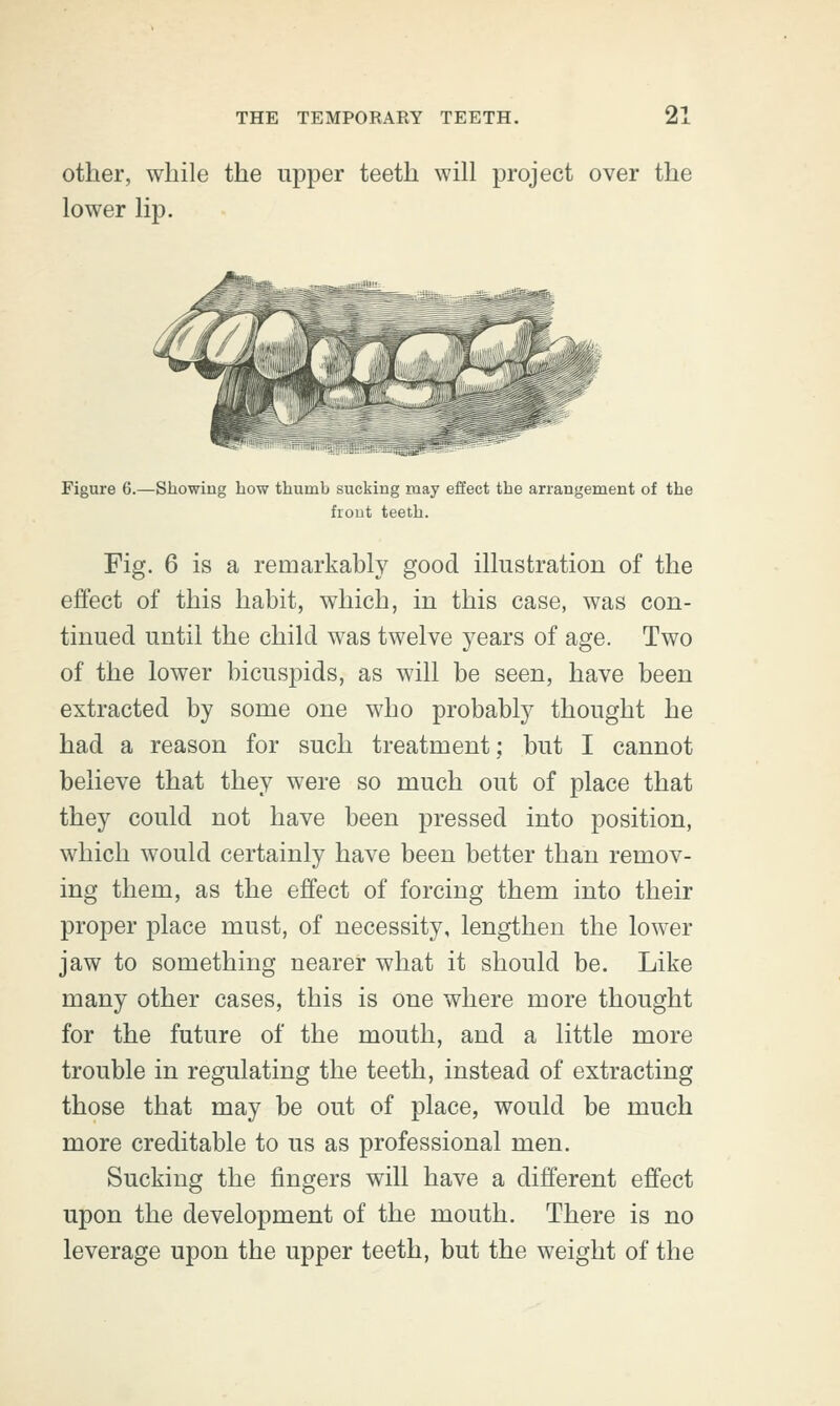 other, while the upper teeth will project over the lower lip. Figure 6.—Showing bow thumb sucking may effect the arrangement of the frout teeth. Fig. 6 is a remarkably good illustration of the effect of this habit, which, in this case, was con- tinued until the child was twelve years of age. Two of the lower bicuspids, as will be seen, have been extracted by some one who probably thought he had a reason for such treatment; but I cannot believe that they were so much out of place that they could not have been pressed into position, which would certainly have been better than remov- ing them, as the effect of forcing them into their proper place must, of necessity, lengthen the lower jaw to something nearer what it should be. Like many other cases, this is one where more thought for the future of the mouth, and a little more trouble in regulating the teeth, instead of extracting those that may be out of place, would be much more creditable to us as professional men. Sucking the fingers will have a different effect upon the development of the mouth. There is no leverage upon the upper teeth, but the weight of the