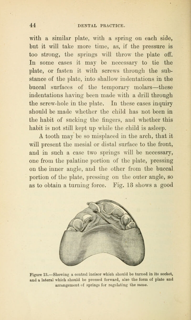 with a similar plate, with a spring on each side, but it will take more time, as, if the pressure is too strong, the springs will throw the plate off. In some cases it may be necessary to tie the plate, or fasten it with screws through the sub- stance of the plate, into shallow indentations in the buccal surfaces of the temporary molars—these indentations having been made with a drill through the screw-hole in the plate. In these cases inquiry should be made whether the child has not been in the habit of sucking the fingers, and whether this habit is not still kept up while the child is asleep. A tooth may be so misplaced in the arch, that it will present the mesial or distal surface to the front, and in such a case two springs will be necessary, one from the palatine portion of the plate, pressing on the inner angle, and the other from the buccal portion of the plate, pressing on the outer angle, so as to obtain a turning force. Fig. 13 shows a good Figure 13.—Showing a central incisor which should be turned in its socket, and a lateral which should be pressed forward, also the form of plate and arrangement of springs for regulating the same.