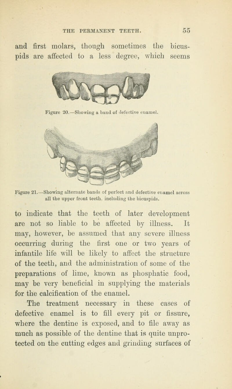 and first molars, though sometimes the bicus- pids are affected to a less degree, which seems Figure 20.—Showing a baud of defective euawel. Figure 21.—Showing alternate bands of perfect and defective enamel across all the upper front teeth, including the bicuspids. to indicate that the teeth of later development are not so liable to be affected by illness. It may, however, be assumed that any severe illness occurring during the first one or two years of infantile life will be likely to affect the structure of the teeth, and the administration of some of the preparations of lime, known as phosphatic food, may be very beneficial in supplying the materials for the calcification of the enamel. The treatment necessary in these cases of defective enamel is to fill every pit or fissure, where the dentine is exposed, and to file away as much as possible of the dentine that is quite unpro- tected on the cutting edges and grinding surfaces of