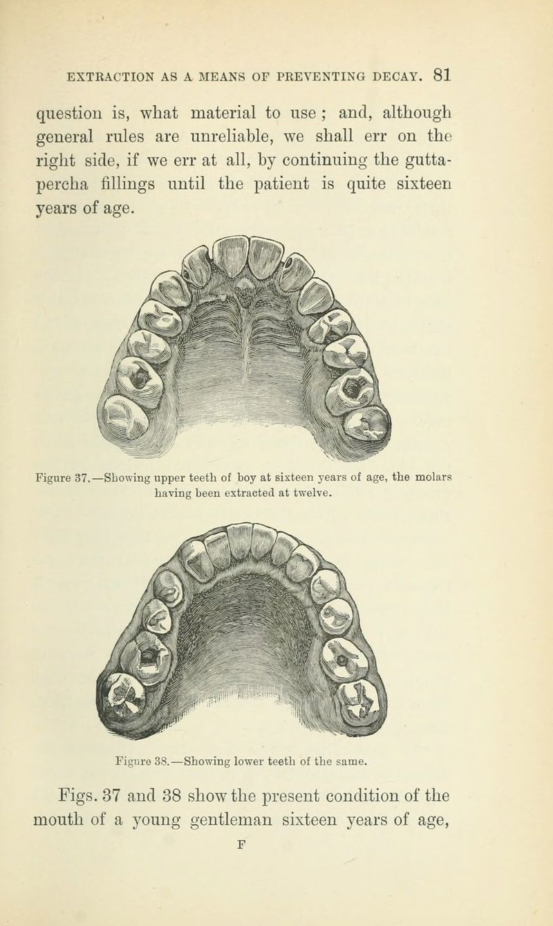 question is, what material to use ; and, although general rules are unreliable, we shall err on the right side, if we err at all, by continuing the gutta- percha fillings until the patient is quite sixteen years of age. Figure 37.—Showing upper teeth of boy at sixteen years of age, the molars having been extracted at twelve. Figure 38.—Showing lower teeth of the same. Figs. 37 and 38 show the present condition of the mouth of a young gentleman sixteen years of age, F