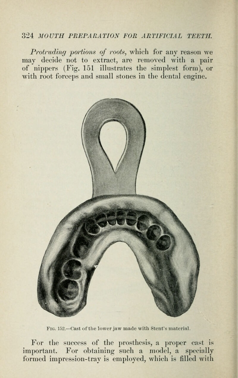 Protruding portions of roots, which for any reason we may decide not to extract, are removed with a pair of nipjjers (Fig. 151 illustrates the simplest form), or with root forceps and small stones in the dental engine. Fig. 152.—Cast of the lower jaw made with Stent's material. For the success of the prosthesis, a jiroper ca.<t is important. For obtaining such a model, a specially formed impression-tray is employed, which is filled with i