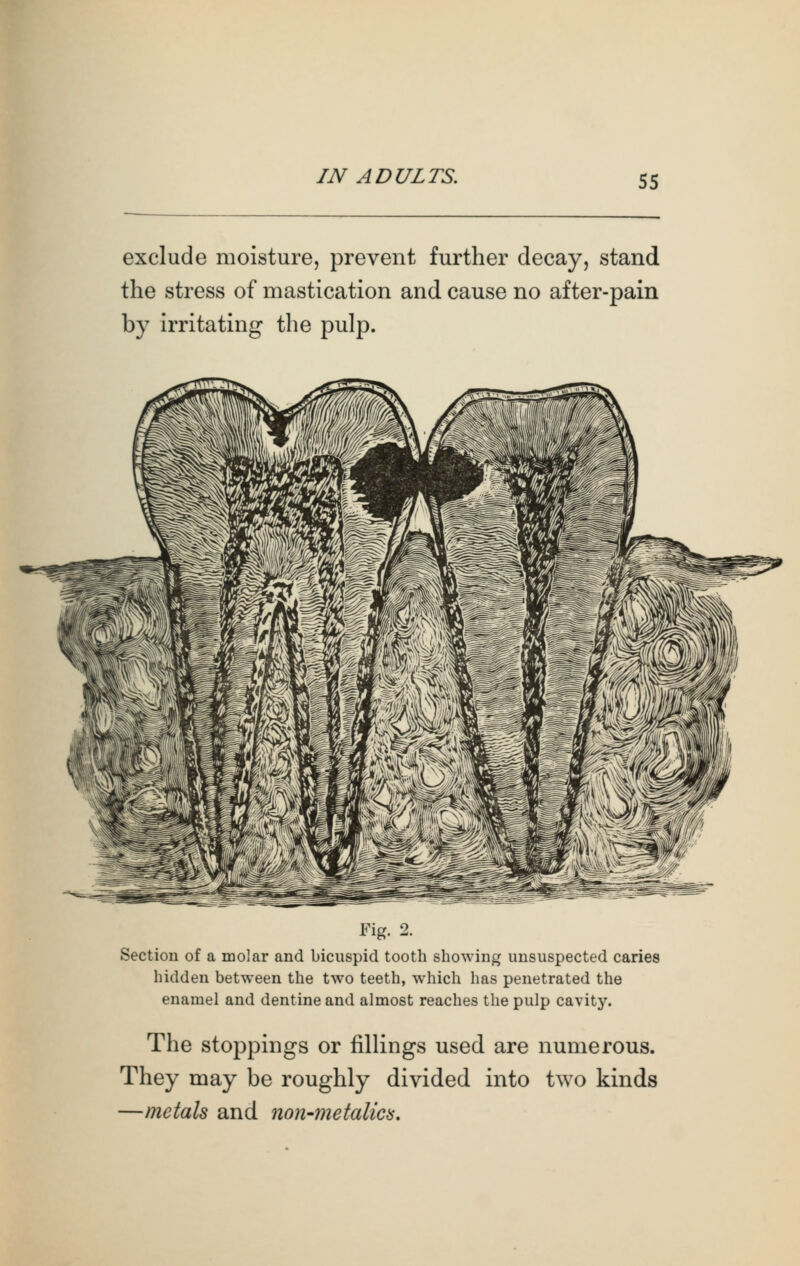 exclude moisture, prevent further decay, stand the stress of mastication and cause no after-pain by irritating the pulp. Fig. 2. Section of a molar and bicuspid tooth showing unsuspected caries hidden between the two teeth, which has penetrated the enamel and dentine and almost reaches the pulp cavity. The stoppings or fillings used are numerous. They may be roughly divided into two kinds —metals and non-metalics.