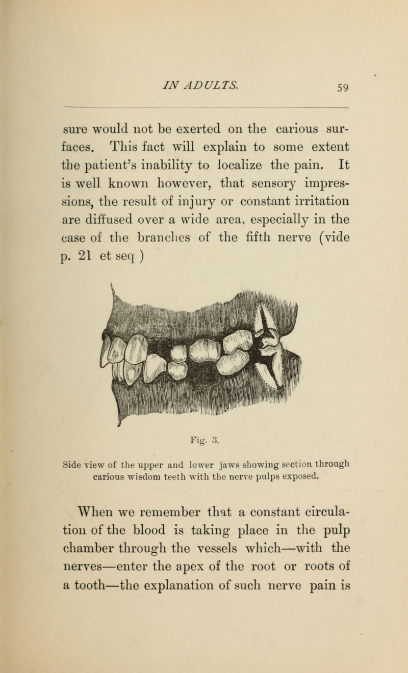 sure would not be exerted on the carious sur- faces. This fact will explain to some extent the patient's inabiUty to localize the pain. It is well known however, that sensory impres- sions, the result of injury or constant irritation are diffused over a wide area, especially in the case of tlie brandies of the fifth nerve (vide p. 21 et seq ) Fig. ;3. Side Tiew of the upper and lower jaws showing section through carious wisdom teeth with the nerve pulps exposed. When we remember that a constant circula- tion of the blood is taking place in tlie pulp chamber through the vessels which—with the nerves—enter the apex of the root or roots of a tooth—the explanation of such nerve pain is