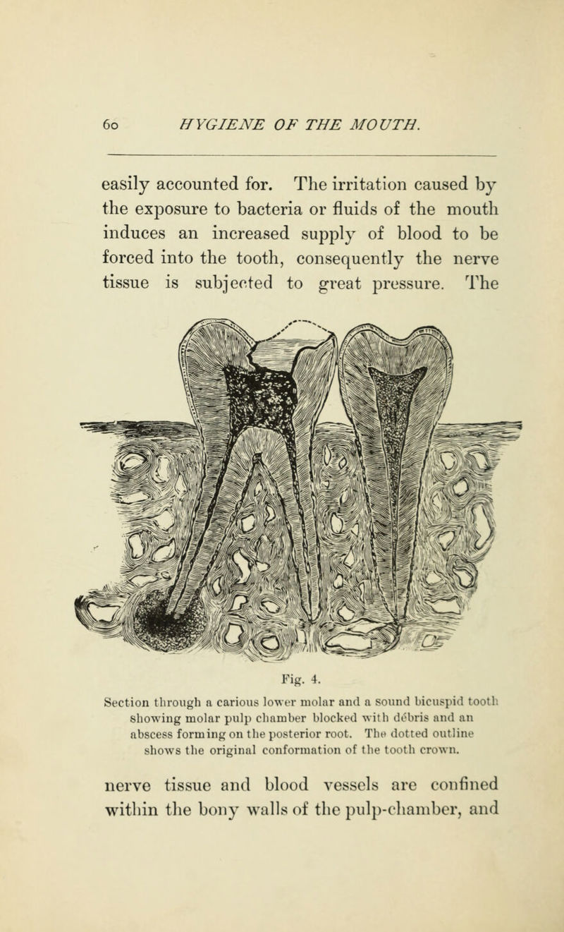 easily accounted for. The irritation caused by the exposure to bacteria or fluids of the mouth induces an increased supply of blood to be forced into the tooth, consequently the nerve tissue is subjected to great pressure. The '■'^C^^ Fig. 4. Section through a carious lower mohir and a sound bicuspid tooth showing molar pulp chamber blocked with debris and an abscess forming on the posterior root. Tlu» dotted outline shows the original conformation of the tooth crown. nerve tissue and blood vessels are confined within the bony walls of the piil})-chaniber, and