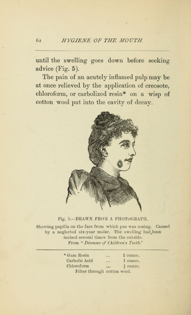 until the swelling goes down before seeking advice (Fig. 5). The pain of an acutely inflamed pulp may be at once relieved by the application of creosote, chloroform, or carbolized resin* on a wisp of cotton wool put into the cavity of decay. Fig. 5.—DRAWN FROM A rilOTOGRAril. Showing papilla on the face from which i)us was oozing. Caused by a neglected six-year molar. The swelling had^been incised several times from the outside. From *' Diseases of Children's Teeth.'' * Gum Resin ... 1 ounce. Carbolic Acid ... 1 ounce. Chloroform ... \ ounce. Filter through cotton wool.