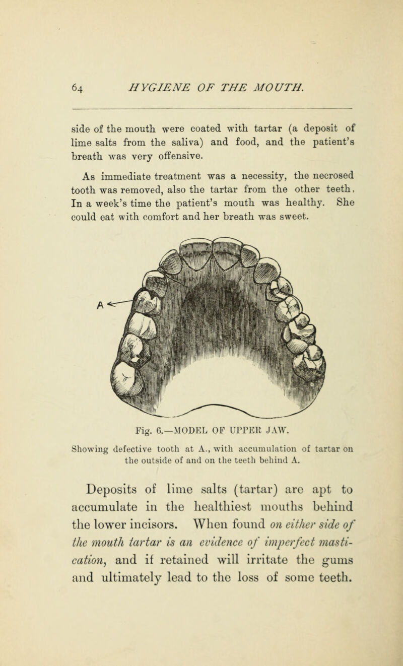 side of the moutli were coated with tartar (a deposit of lime salts from the saliva) and food, and the patient's breath was very offensive. As immediate treatment was a necessity, the necrosed tooth was removed, also the tartar from the other teeth. In a week's time the patient's mouth was healthy. She could eat with comfort and her breath was sweet. Fig. 6.—MODEL OF UPPER JAW. Showing defective tooth at A., with accumulation of tartar on the outside of and on the teetli behind A. Deposits of lime salts (tartar) arc apt to accumulate in the healthiest mouths behind the lower incisors. When found on either side of the mouth tartar is an evidence of imperfect masti- cation^ and if retained will irritate the gums and ultimately lead to the loss of some teeth.