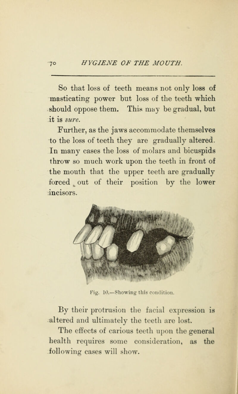 So that loss of teeth means not only loss of masticating power but loss of the teeth which should oppose them. This may be gradual, but it is sure. Further, as the jaws accommodate themselves to the loss of teeth they are gradually altered. In many cases the loss of molars and bicuspids throw so much work upon the teeth in front of the mouth that the upper teeth are gradually forced ^ out of their position by the lower incisors. Pig. 10.—Showing this condition. By their protrusion the facial expression is altered and ultimately the teetli are lost. The effects of carious teeth upon the general health requires some consideration, as the -following cases will show.