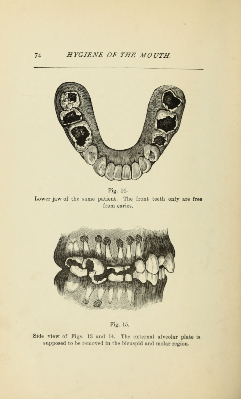 Fig. 14. Lower jaw of the same patient. The front teeth only are fre« from caries. Fig. 15. Side view of Figs. 13 and 14. The external alveolar plate is supposed to be removed in the bicuspid and molar region.