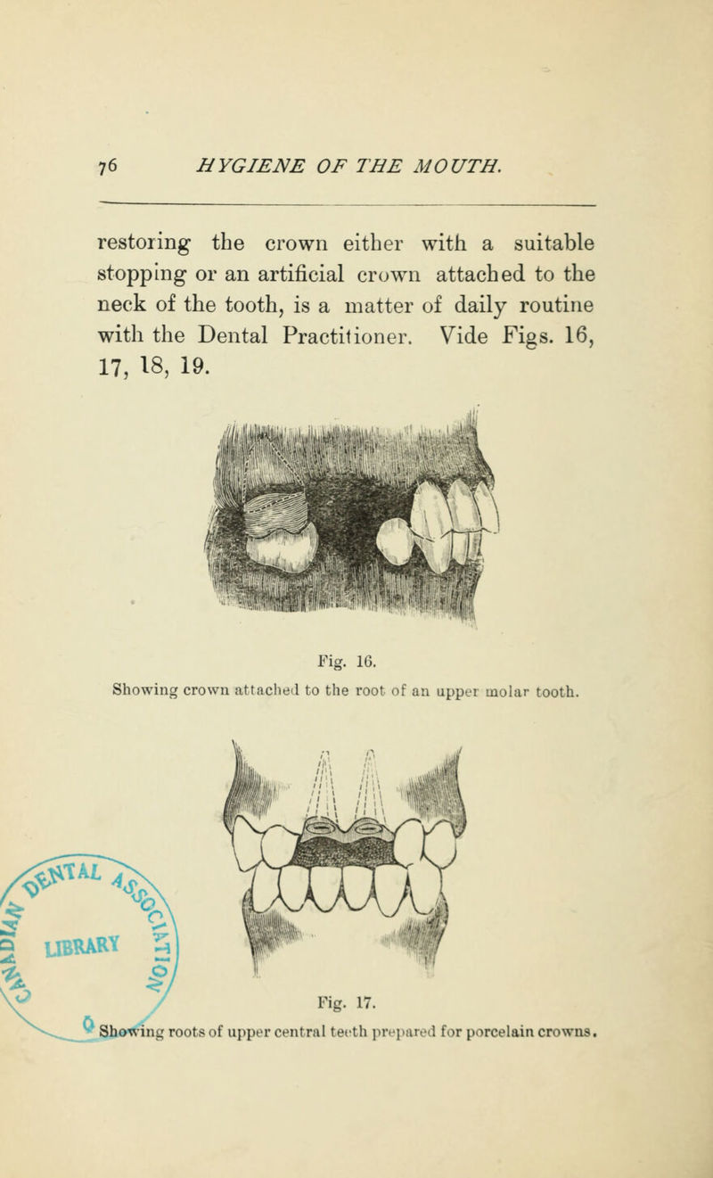 restoring the crown either with a suitable stopping or an artificial crown attached to the neck of the tooth, is a matter of daily routine with the Dental Practitioner. Vide Figs. 16, 17, 18, 19. Fig. 16. Showing crown attached to the root of an upper molar tooth. Fig. 17. Sho^'ing roots of upper central teeth inv])ared for porcelain crowns.