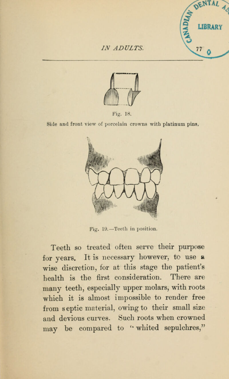 2 LIBRARY IN ADULTS. Fig. 18. Side and front view of porcelain crowns with platinum pins. Fig. 19.—Teeth in position. Teeth so treated often serve their purpose for years. It is necessary however, to use a wise discretion, for at this stage the patient's health is the first consideration. There are many teeth, especially upper molars, with roots which it is almost impossible to render free from septic material, owing to their small size and devious curves. Such roots when crowned may be compared to  whited sepulchres,