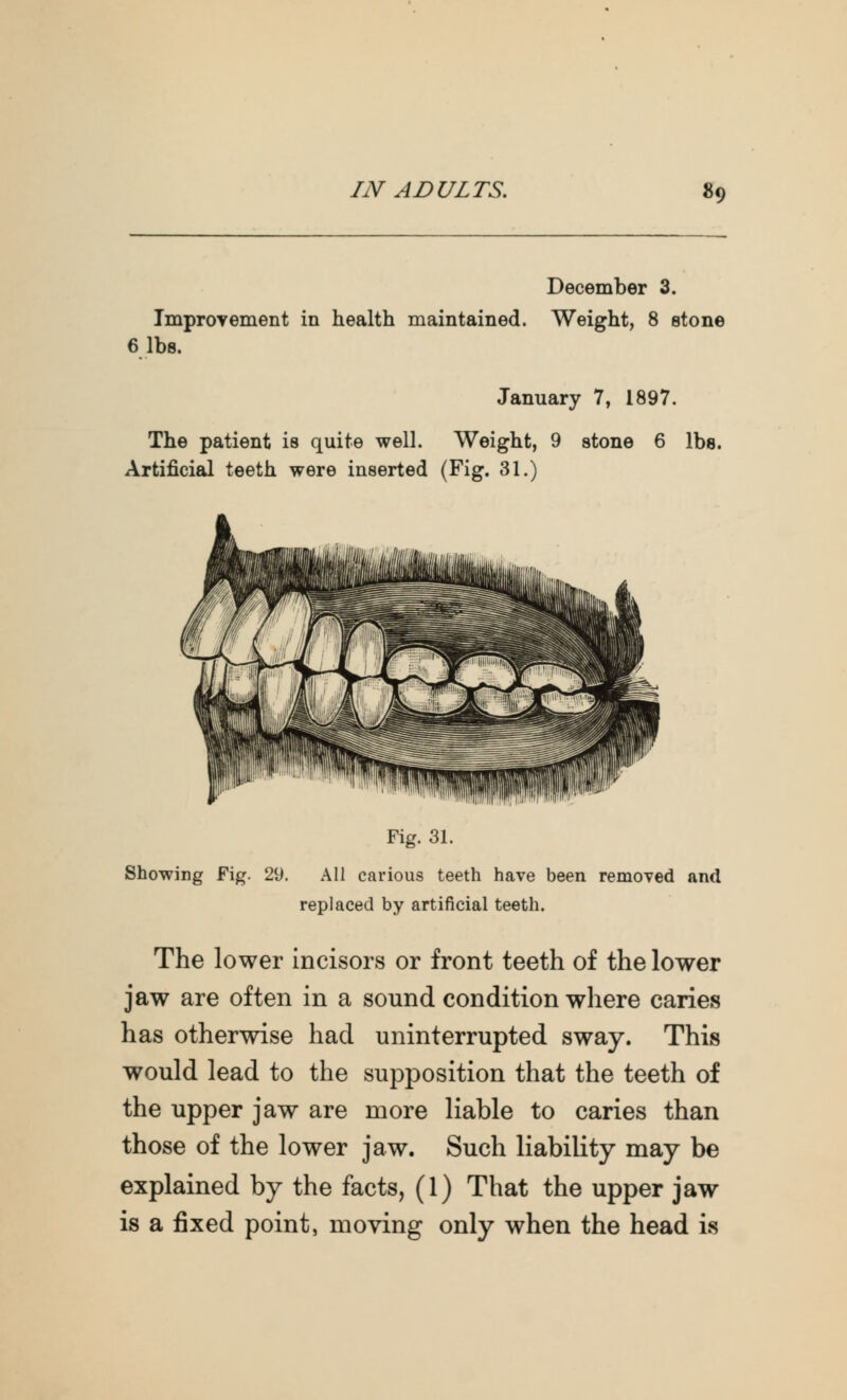 December 3. Improvement in health maintained. Weight, 8 stone 6 lbs. January 7, 1897. The patient is quite well. Weight, 9 stone 6 lbs. Artificial teeth were inserted (Fig. 31.) Fig. 31. Showing Fig. 29. All carious teeth have been removed and replaced by artificial teeth. The lower incisors or front teeth of the lower jaw are often in a sound condition where caries has otherwise had uninterrupted sway. This would lead to the supposition that the teeth of the upper jaw are more liable to caries than those of the lower jaw. Such liability may be explained by the facts, (1) That the upper jaw is a fixed point, moving only when the head is