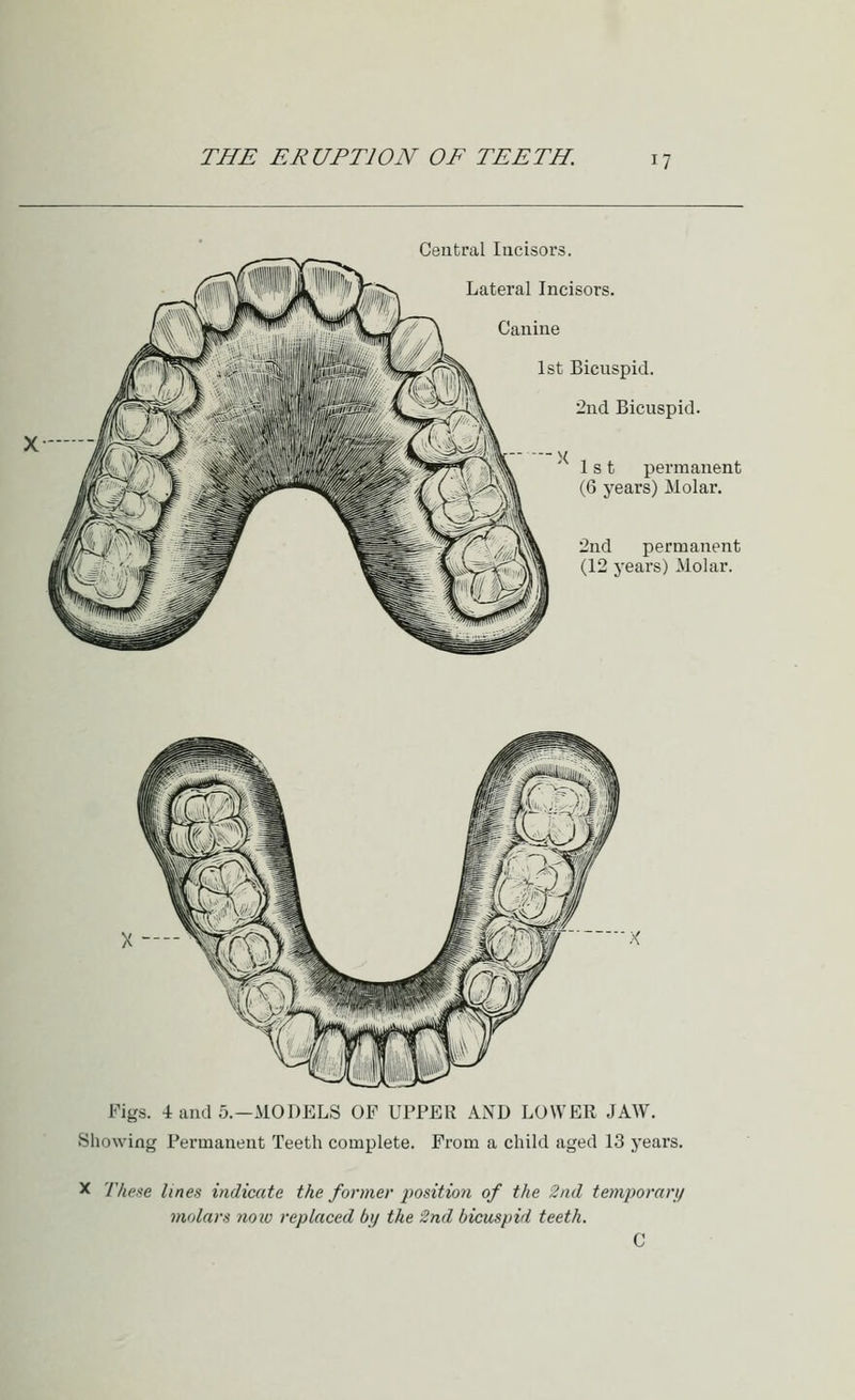 Central Incisors. Lateral Incisors. Canine 1st Bicuspid. 2nd Bicuspid. 1st permanent (6 years) ilolar. 2nd permanent (12 years) Molar. Figs. 4 and 5.—MODELS OF UPPER AND LOWER JAW. Showing Permanent Teeth complete. From a child aged 13 years. X '/'/jp.se lines indicate the former 2>osition of the 2n(l temporary molars now replaced by the 2nd bicuspid teeth. C