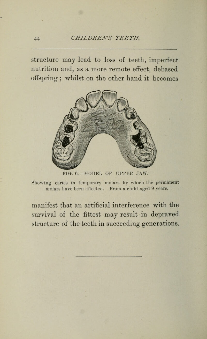 structure may lead to loss of teeth, imperfect nutrition and, as a more remote effect, debased offspring ; wliilst on the other hand it becomes flG. G.—MODEL OF UPPER JAW. Showing caries in temporary molars by -which the permanent molars have been affected. From a child aged 9 years. manifest that an artificial interference with the survival of the fittest may result in depraved structure of the teeth in succeeding generations.