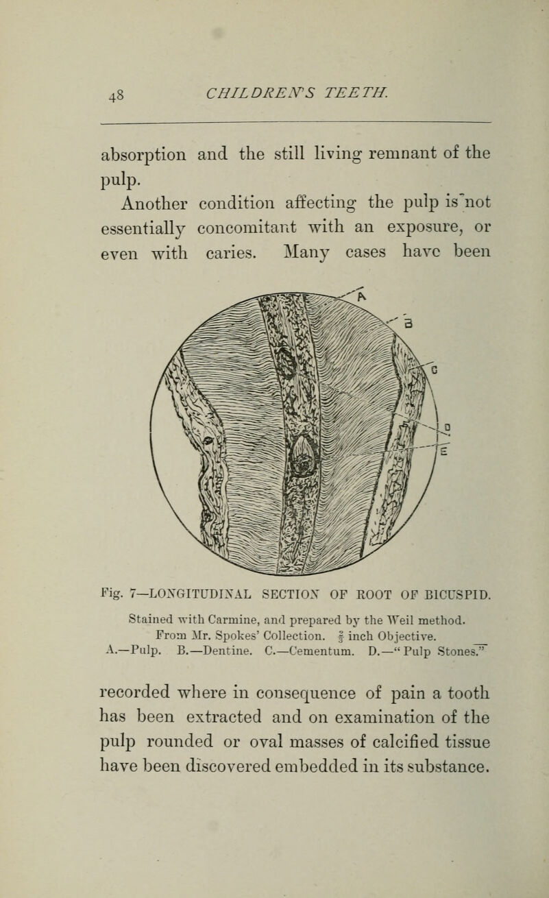 absorption and the still living remnant of the pulp. Another condition affecting the pulp isnot essentially concomitant with an exposure, or even with caries. Many cases have been Fig. 7—LOXGITUDINAL SECTIOX OF ROOT OF BICUSPID. Stained with Carmine, and prepared by the Weil method. From Mr. Spokes' Collection. | inch Objective. A.—Pulp. B.—Dentine. C—Cementum. D.—Pulp StonesT^ recorded where in consequence of pain a tooth has been extracted and on examination of the pulp rounded or oval masses of calcified tissue have been discovered embedded in its substance.