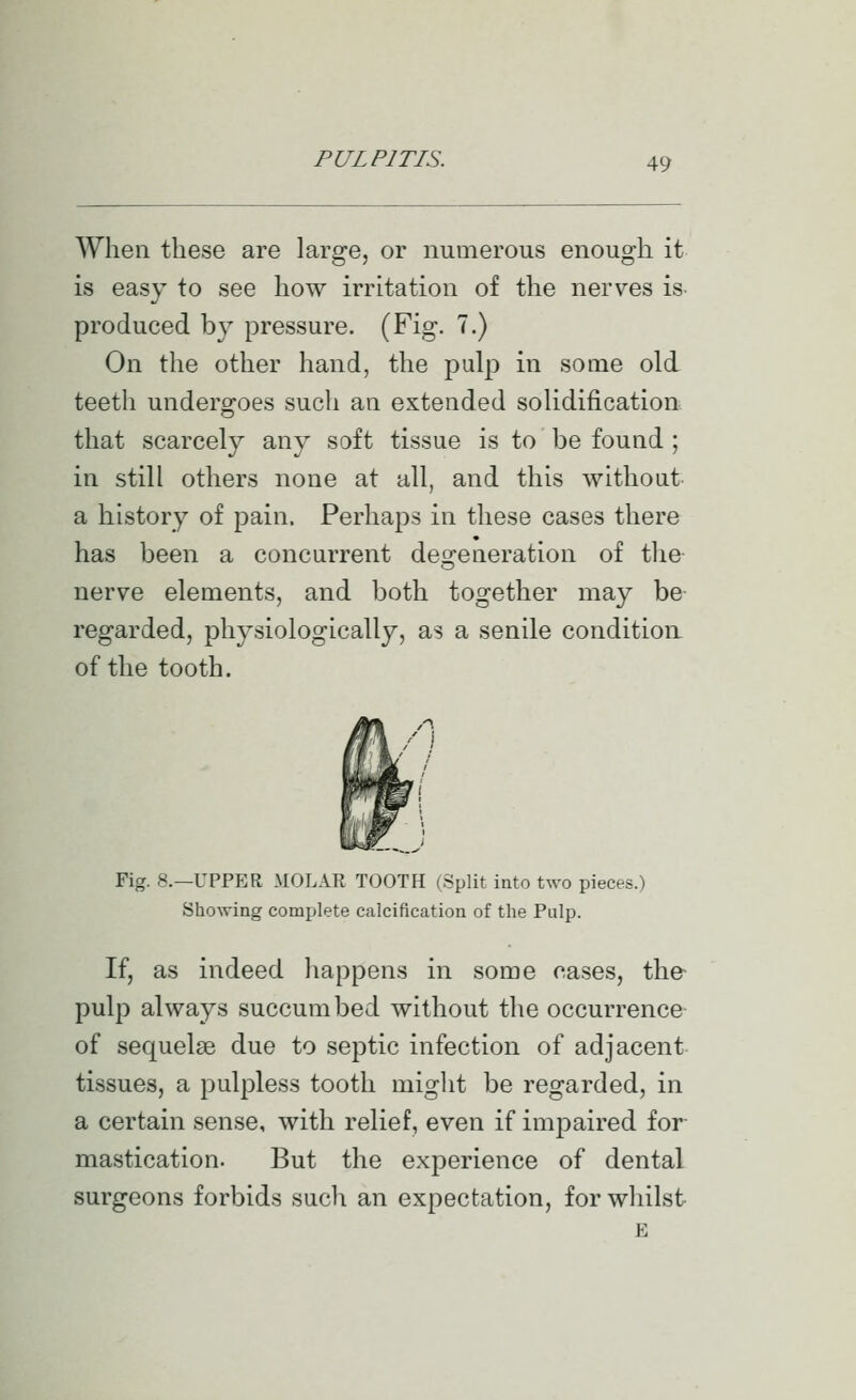 When these are large, or numerous enough it is easy to see how irritation of the nerves is produced by pressure. (Fig. 7.) On the other hand, the pulp in some old teeth undergoes such an extended solidification that scarcely any soft tissue is to be found; in still others none at all, and this without a history of pain. Perhaps in these cases there has been a concurrent deo:eneration of the nerve elements, and both together may be regarded, physiologically, as a senile condition of the tooth. Fig. 8.—UPPER MOLAR TOOTH (Split into two pieces.) Showing complete calcification of the Pulp. If, as indeed happens in some ca.ses, the pulp always succumbed without the occurrence of sequel£e due to septic infection of adjacent tissues, a pulpless tooth might be regarded, in a certain sense, with relief, even if impaired for mastication. But the experience of dental surgeons forbids such an expectation, for whilst E