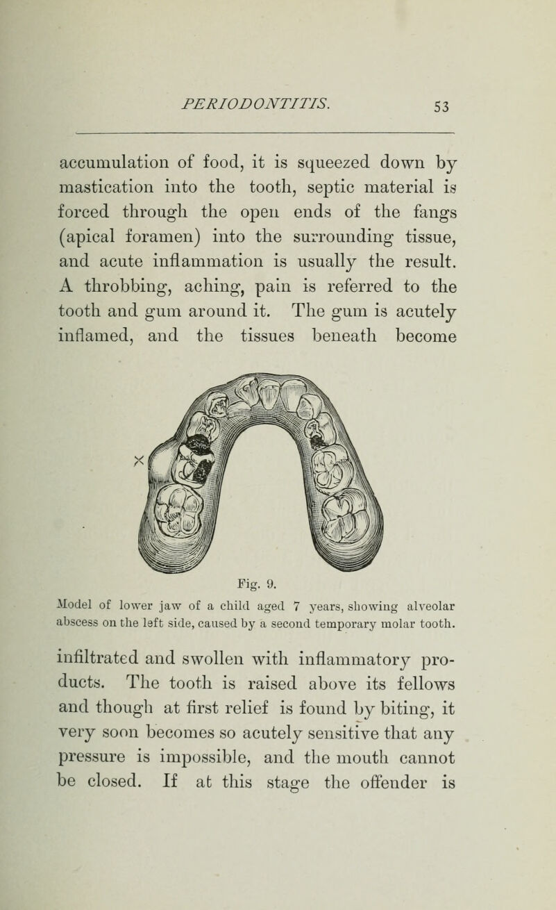 accumulation of food, it is squeezed down by mastication into the tooth, septic material is forced through the open ends of the fangs (apical foramen) into the surrounding tissue, and acute inflammation is usually the result. A throbbing, aching, pain is referred to the tooth and gum around it. The gum is acutely inflamed, and the tissues beneath become Fig. 9. Model of lower jaw of a child aged 7 years, showing alveolar abscess on the left side, caused by a second temporary molar tooth. infiltrated and swollen with inflammatory pro- ducts. The tooth is raised above its fellows and though at first relief is found by biting, it very soon becomes so acutely sensitive that any pressure is impossible, and the mouth cannot be closed. If at this stage the offender is