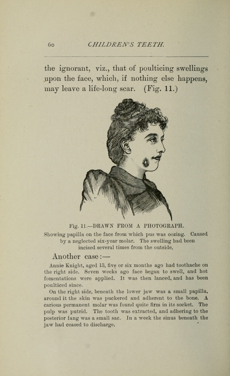 the ignorant, viz., that of poulticing swellings upon the face, which, if nothing else happens, may leave a life-long scar. (Fig. 11.) Fig. 11 —DRAWX FEOM A PHOTOGRArH. Showing papilla on the face from which pus was ooziug. Caused by a neglected six-year molar. The swelling had been incised several times from the outside, Another case:— Annie Knight, aged 13, five or six months ago had toothache on the right side. Seven weeks ago face began to swell, and hot fomentations were applied. It was then lanced, and has been poulticed since. On the right side, beneath the lower jaw was a small papilla, around it the skin was puckered and adherent to the bone. A carious permanent molar was found quite firm in its socket. The pulp was putrid. The tooth was extracted, and adhering to the posterior fang was a small sac. In a week the sinus beneath the jaw had ceased to discharge.