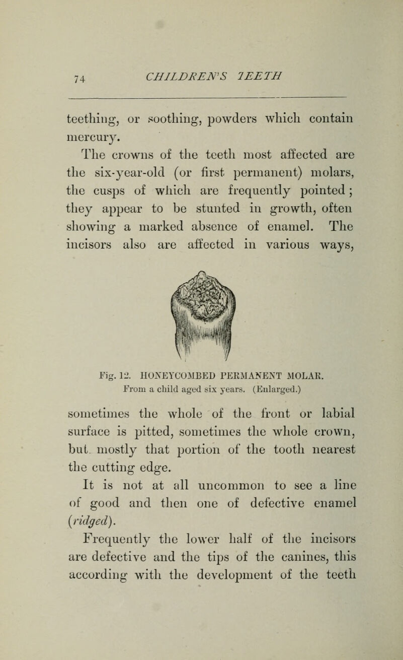 teething, or soothing, powders which contain mercury. The crowns of the teeth most affected are the six-year-old (or first permanent) molars, the cusps of which are frequently pointed; they appear to be stunted in growth, often showing a marked absence of enamel. The incisors also are affected in various ways, Fig. 11'. HONEYCOMBED PERMANENT MOLAR. From a child aged six years. (Enlarged.) sometimes the whole of the front or labial surface is pitted, sometimes the whole crown, but mostly that portion of the tooth nearest the cutting edge. It is not at all uncommon to see a line of good and then one of defective enamel {j'idged). Frequently the lower half of the incisors are defective and the tips of tlie canines, this according with the development of the teeth