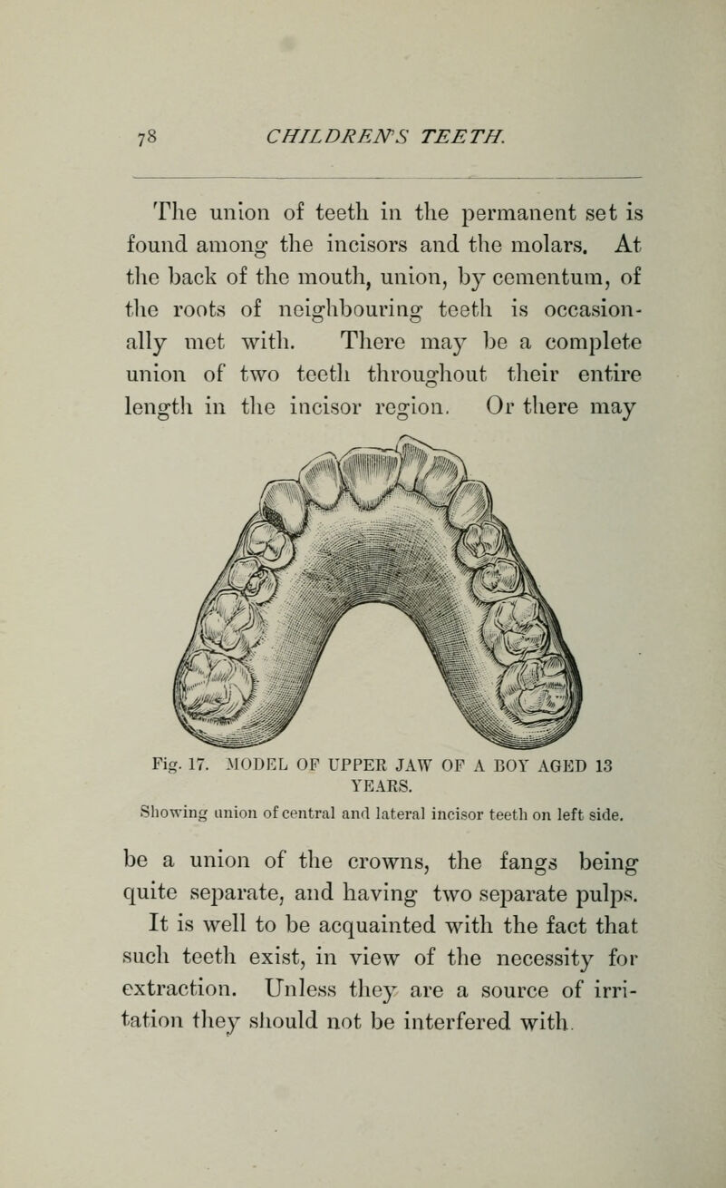 The union of teeth in the permanent set is found among the incisors and the molars. At tlie hack of the mouth, union, by cementum, of \\\Ci roots of neiorhbourino^ teeth is occasion- ally met with. There may be a complete union of two tcetli throughout their entire length in the incisor region. Or there may Fig. 17. -MODEL OF UPPER JAW OF A BOY AGED 13 YEARS. Showing union of central and lateral incisor teeth on left side. be a union of the crowns, the fangs being quite separate, and having two separate pulps. It is well to be acquainted with the fact that such teeth exist, in view of the necessity for extraction. Unless they are a source of irri- tation they should not be interfered with.