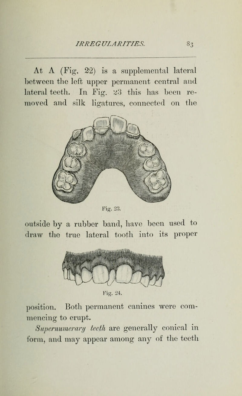 At A (Fig, 22) is a supplemental lateral between the left upper permanent central and lateral teeth. In Fig-, :^'3 this has been re- moved and silk ligatures, connected on the Fig. 23. outside by a rubber band, have been used to draw the true lateral tooth into its proper Fig. 24. position. Both permanent canines were com- mencing to erupt. Siipernumei^arij teeth are generally conical in form, and may appear among any of the teeth