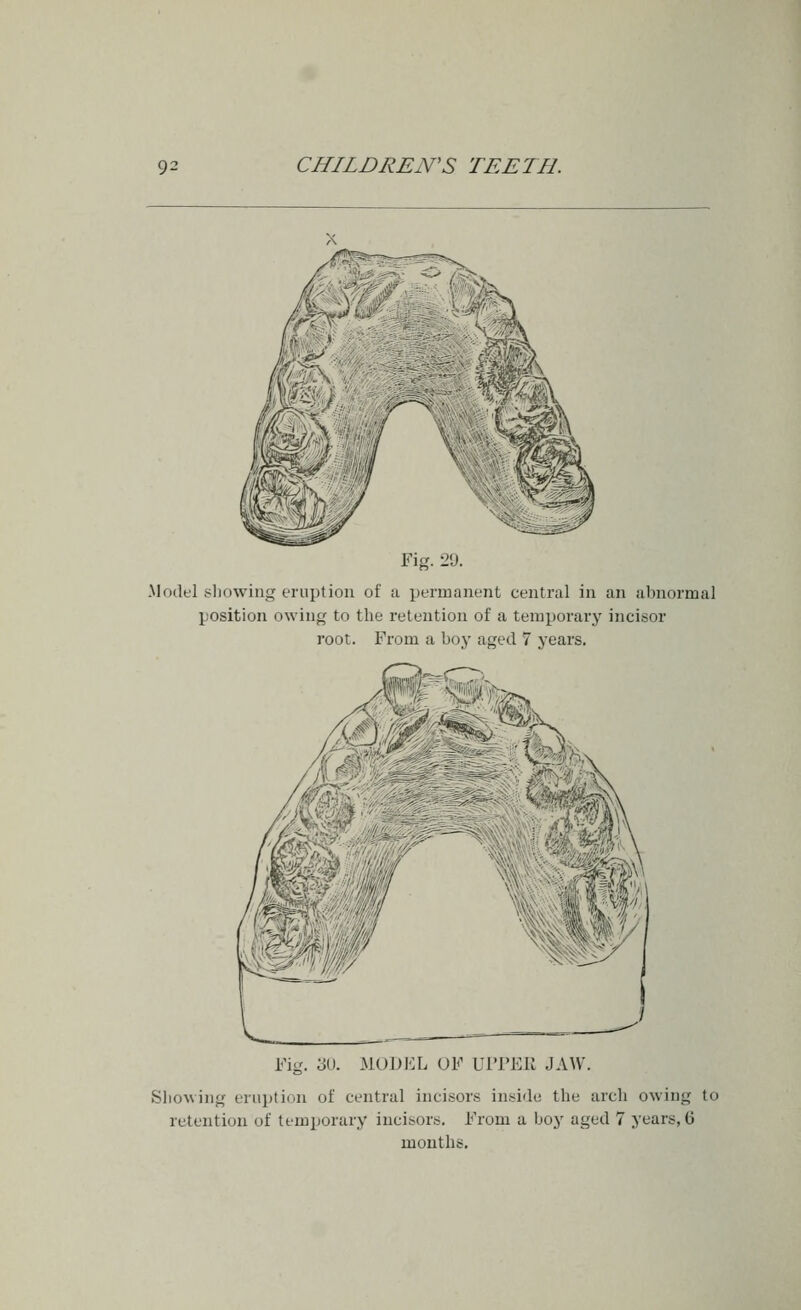 Fig. 20. .Model .showing eruption of a permanent central in an abnormal position owing to the retention of a temporary incisor root. From a boy aged 7 years. MODEL UF UlTEli JAW. Sliowing ernijticin of central incisors inside the arch owing to retention of temporary incisors. From a boy aged 7 years, 6 months.