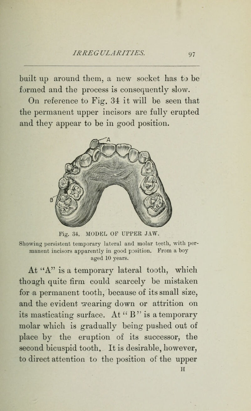 built up around them, a new socket has to be formed and the process is consequently slow. On reference to Fig. 34 it will be seen that the permanent upper incisors are fully erupted and they appear to be in good position. Fig. 34. MODEL OF UPPER JAW. Showing persistent temporary lateral and molar teeth, with per- manent incisors apparently' in good position. From a boy aged 10 years. At A is a temporary lateral tooth, which though quite firm could scarcely be mistaken for a permanent tooth, because of its small size, and the evident wearing down or attrition on its masticating surface. At  B is a temporary molar which is gradually being pushed out of place by the eruption of its successor, the second bicuspid tooth. It is desirable, however, to direct attention to the position of the upper H