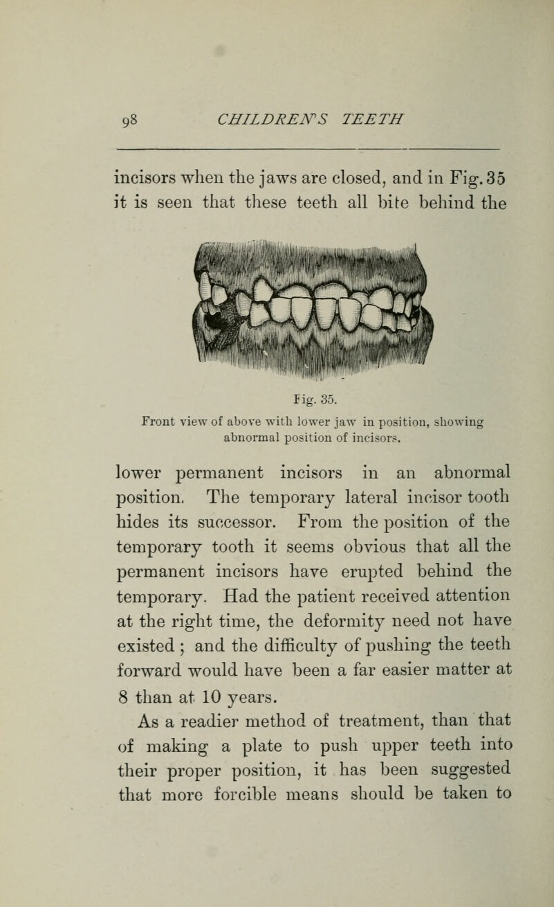 incisors when the jaws are closed, and in Fig. 35 it is seen that these teeth all bite behind the fig. 35. Front view of above Tvith lower jaw in position, showing abnormal position of incisors. lower permanent incisors in an abnormal position. The temporary lateral incisor tooth hides its successor. From the position of the temporary tooth it seems obvious that all the permanent incisors have erupted behind the temporary. Had the patient received attention at the right time, the deformity need not have existed ; and the difficulty of pushing the teeth forward would have been a far easier matter at 8 than at 10 years. As a readier method of treatment, than that of making a plate to push upper teeth into their proper position, it has been suggested that more forcible means should be taken to