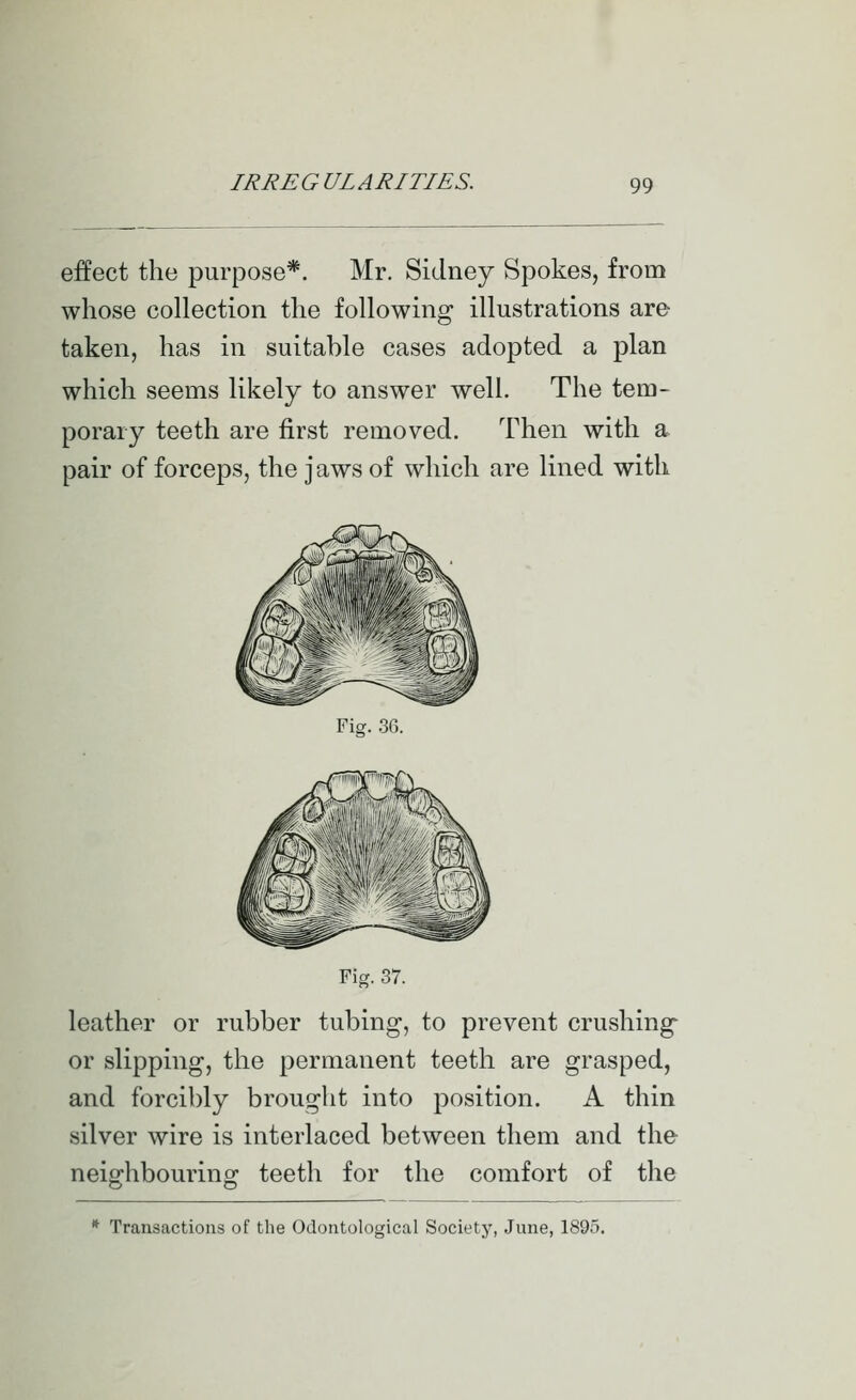 effect the purpose*. Mr. Sidney Spokes, from whose collection the following illustrations are taken, has in suitable cases adopted a plan which seems likely to answer well. The tem- porary teeth are first removed. Then with a pair of forceps, the jaws of which are lined with Fig. 36. Fig. 37. leather or rubber tubing, to prevent crushing or slipping, the permanent teeth are grasped, and forcibly brought into position. A thin silver wire is interlaced between them and the neighbouring teeth for the comfort of the * Transactions of the Odoiitological Society, June, 1895.