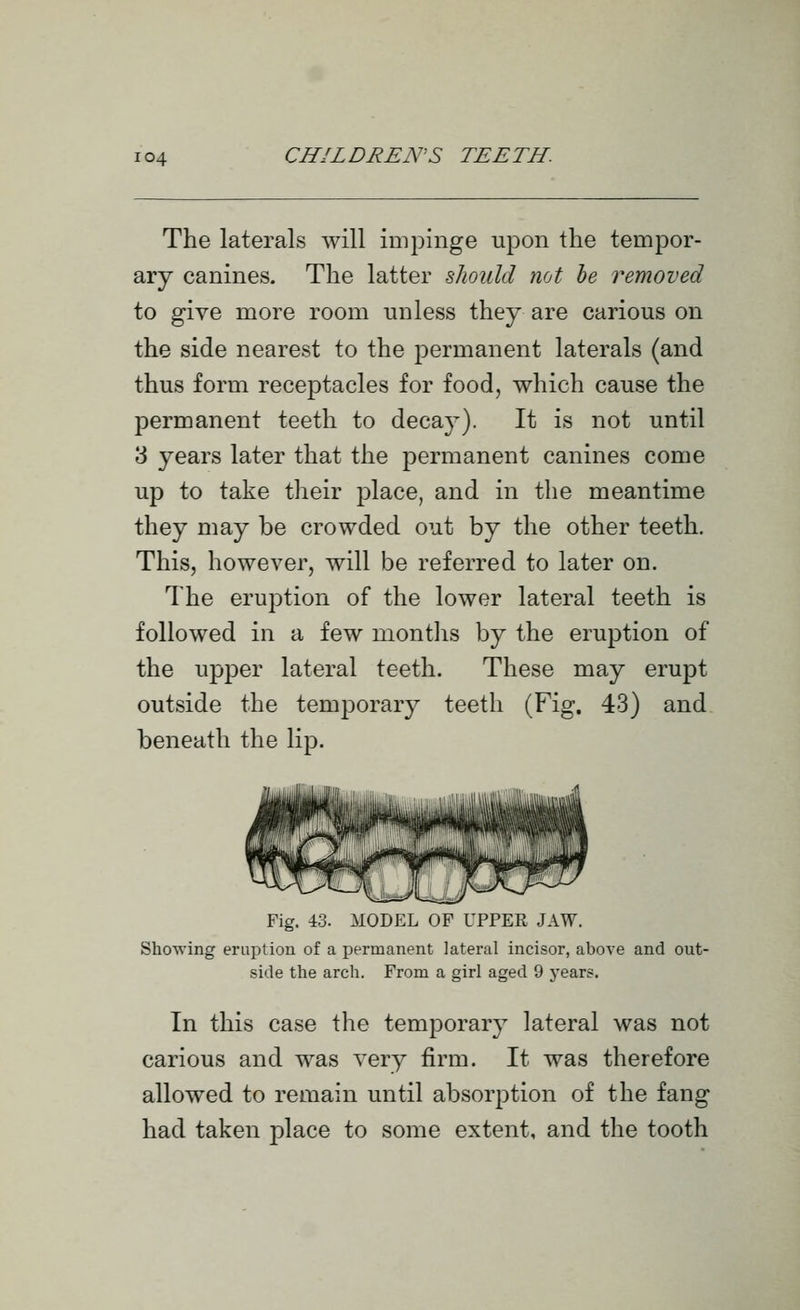 The laterals will impinge upon the tempor- ary canines. The latter should not he removed to give more room unless they are carious on the side nearest to the permanent laterals (and thus form receptacles for food, which cause the permanent teeth to decay). It is not until 3 years later that the permanent canines come up to take their place, and in the meantime they may be crowded out by the other teeth. This, however, will be referred to later on. The eruption of the lower lateral teeth is followed in a few montlis by the eruption of the upper lateral teeth. These may erupt outside the temporary teeth (Fig. 43) and beneath the lip. Fig. 43. MODEL OF UPPER JAW. Showing eruption of a permanent lateral incisor, above and out- side the arch. From a girl aged 9 years. In this case the temporary lateral was not carious and was very firm. It was therefore allowed to remain until absorption of the fang had taken place to some extent, and the tooth