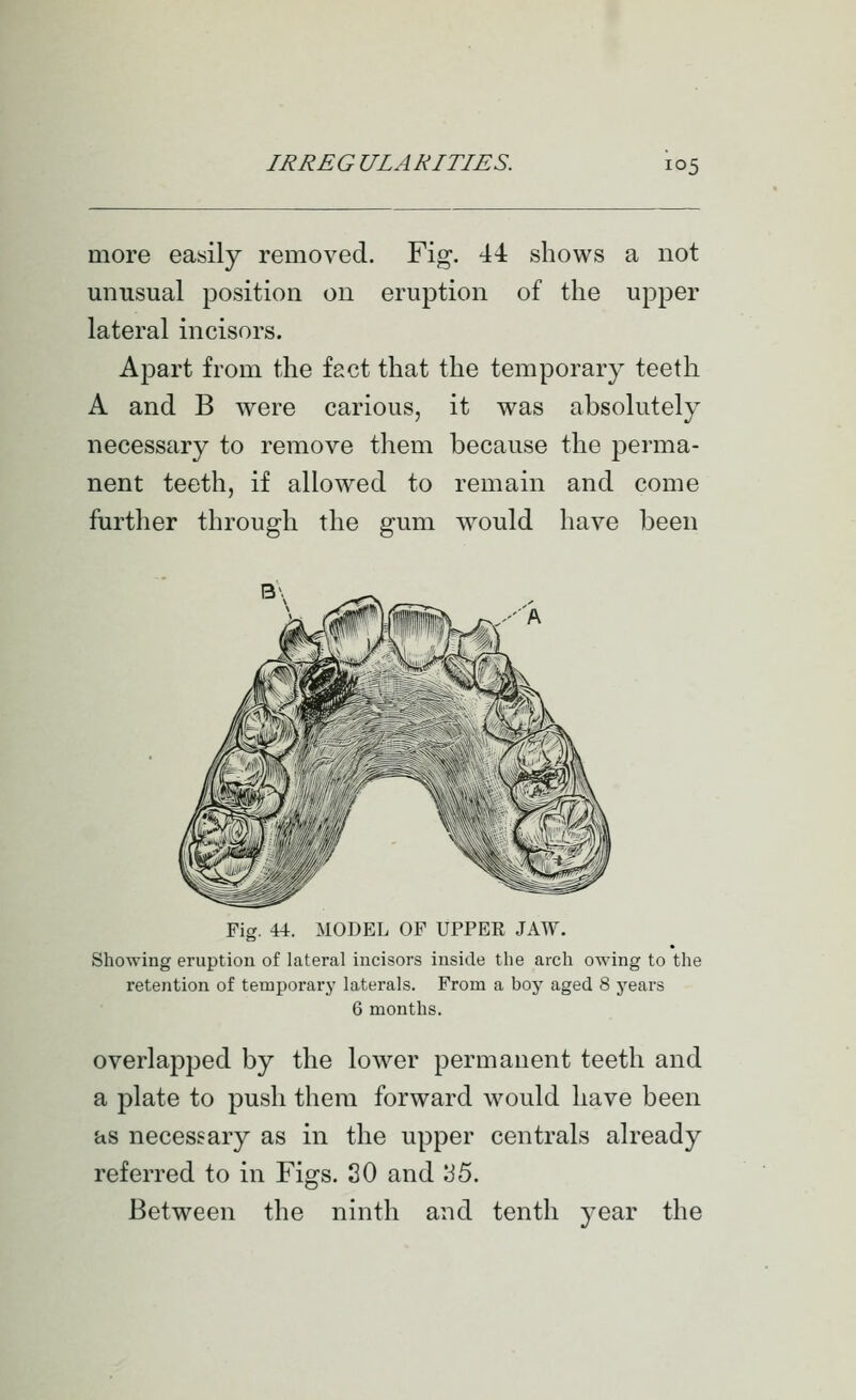 more easily removed. Fig. 44 shows a not unusual position on eruption of the upper lateral incisors. Apart from the fact that the temporary teeth A and B were carious, it was absolutely necessary to remove them because the perma- nent teeth, if allowed to remain and come further through the gum would have been Fig. 44. MODEL OF UPPER JAW. Showing eruption of lateral incisors inside the arch owing to the retention of temporary laterals. From a boy aged 8 years 6 months. overlapped by the lower permanent teeth and a plate to push them forward would have been as necessary as in the upper centrals already referred to in Figs. 80 and JJS. Between the ninth and tenth year the