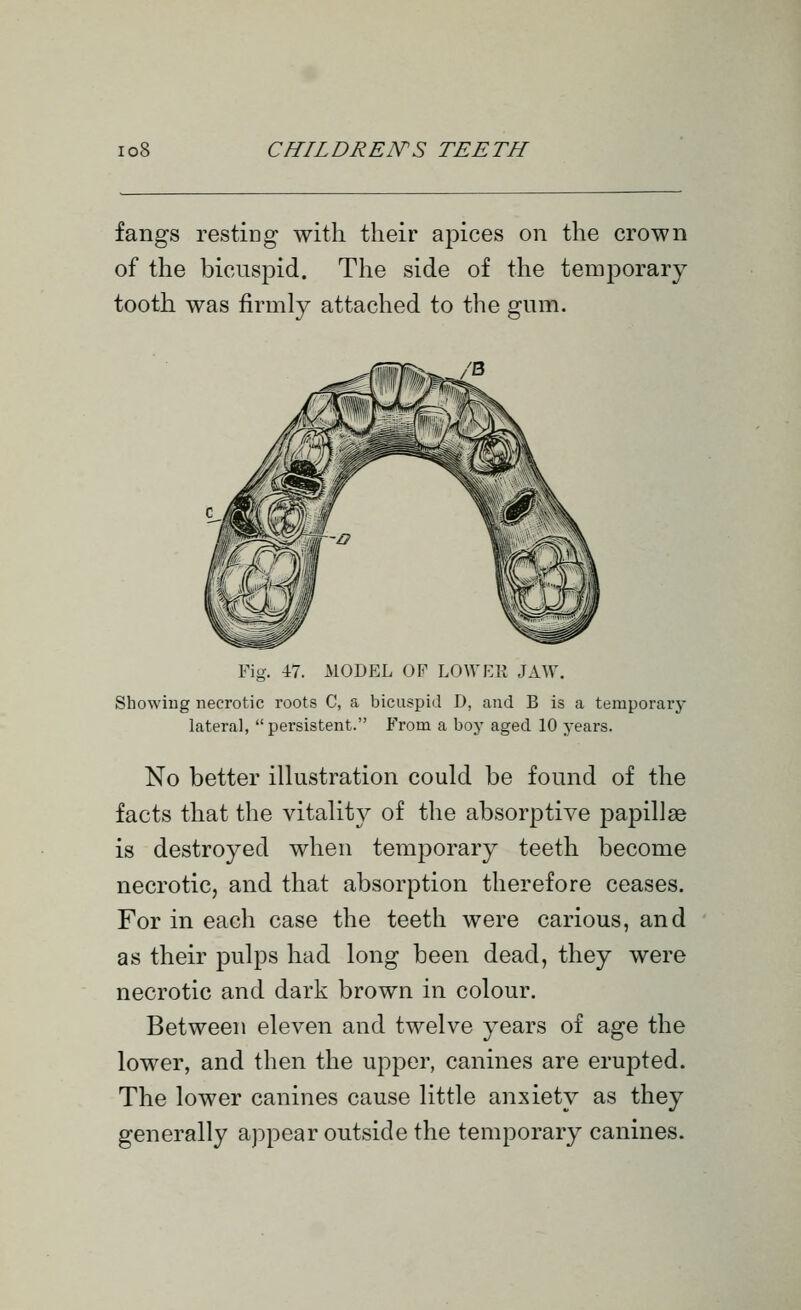 fangs resting with their apices on the crown of the bicuspid. The side of the temporary tooth was firmly attached to the gum. Fig. 47. MODEL OF LOWER JAW. Showiug necrotic roots C, a bicuspid D, and B is a temporary Lateral, persistent. From a boy aged 10 years. No better illustration could be found of the facts that the vitality of the absorptive papillae is destroyed when temporary teeth become necrotic, and that absorption therefore ceases. For in each case the teeth were carious, and as their pulps had long been dead, they were necrotic and dark brown in colour. Between eleven and twelve years of age the lower, and then the upper, canines are erupted. The lower canines cause little anxiety as they generally appear outside the temporary canines.