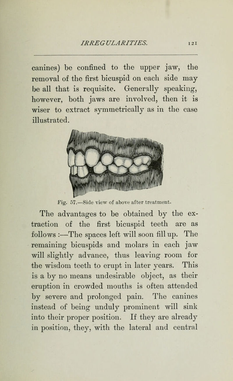 canines) be confined to the upper jaw, the removal of the first bicuspid on each side may be all that is requisite. Generally speaking, however, both jaws are involved, then it is wiser to extract symmetrically as in the case illustrated. Fig. 57.—Side view of above after treatment. The advantages to be obtained by the ex- traction of the first bicuspid teeth are as follows :—The spaces left will soon fill up. The remaining bicuspids and molars in each jaw will slightly advance, thus leaving room for the wisdom teeth to erupt in later years. This is a by no means undesirable object, as their eruption in crowded mouths is often attended by severe and prolonged pain. The canines instead of being unduly prominent will sink into their proper position. If they are already in position, they, with the lateral and central