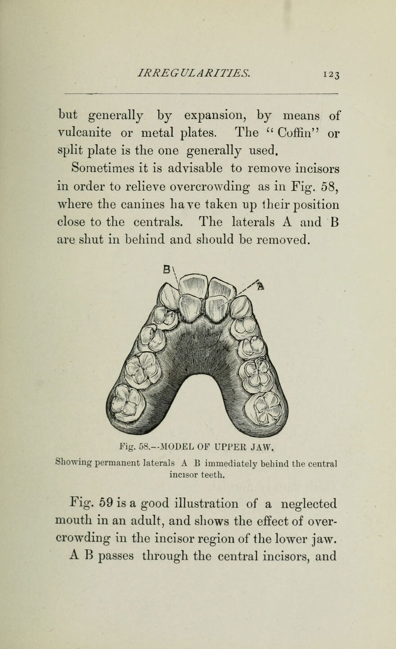 but generally b}^ expansion, by means of vulcanite or metal plates. The  Coffin or split plate is the one generally used. Sometimes it is advisable to remove incisors in order to relieve overcrowding as in Fig. 58, where the canines have taken up Iheir position close to the centrals. The laterals A and B are shut in behind and should be removed. Fig. 58.—MODEL OF UPPER JAW. Showing permanent laterals A B immediately behind the central incisor teeth. Fig. 69 is a good illustration of a neglected mouth in an adult, and shows the effect of over- crowding in the incisor region of the lower jaw. A B passes through the central incisors, and