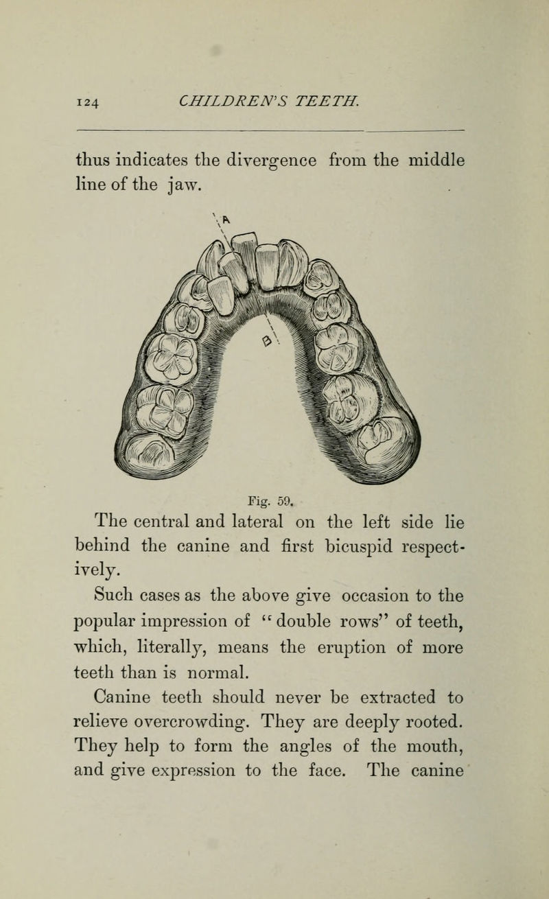 thus indicates the divergence from the middle line of the jaw. Fig. 59. The central and lateral on the left side lie behind the canine and first bicuspid respect- ively. Such cases as the above give occasion to the popular impression of double rows of teeth, which, literally, means the eruption of more teeth than is normal. Canine teeth should never be extracted to relieve overcrowding. They are deeply rooted. They help to form the angles of the mouth, and give expression to the face. The canine