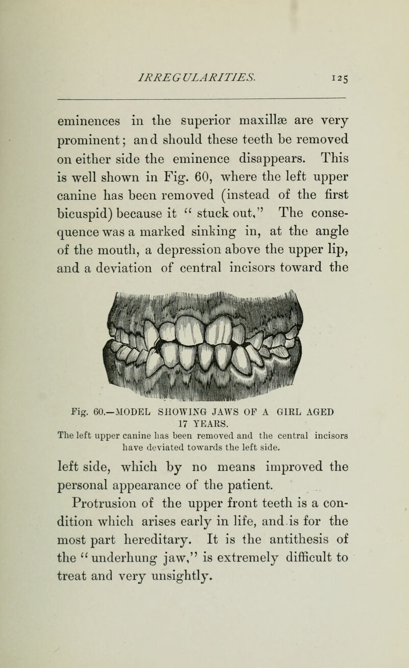 eminences in the superior maxillae are very prominent; and should these teeth be removed on either side the eminence disappears. This is well shown in Fig. 60, where the left upper canine has been removed (instead of the first bicuspid) because it ''stuck out, The conse- quence was a marked sinking in, at the angle of the mouth, a depression above the upper lip, and a deviation of central incisors toward the Fig. 60.—MODEL SllOWlxXG JAWS OF A GIRL AGED 17 YEARS. The left upper cauine has been removed and the central incisors have deviated towards the left side. left side, which by no means improved the personal appearance of the patient. Protrusion of the upper front teeth is a con- dition which arises early in life, and.is for the most part hereditary. It is the antithesis of the underhung jaw, is extremely difficult to treat and very unsightly.